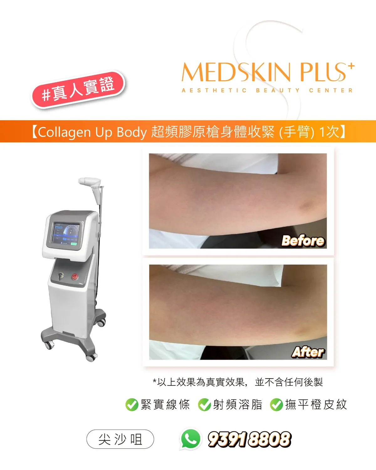 Collagen Up Body 超頻膠原槍手臂療程前後對比照片，左側為儀器，右側為兩張手臂特寫