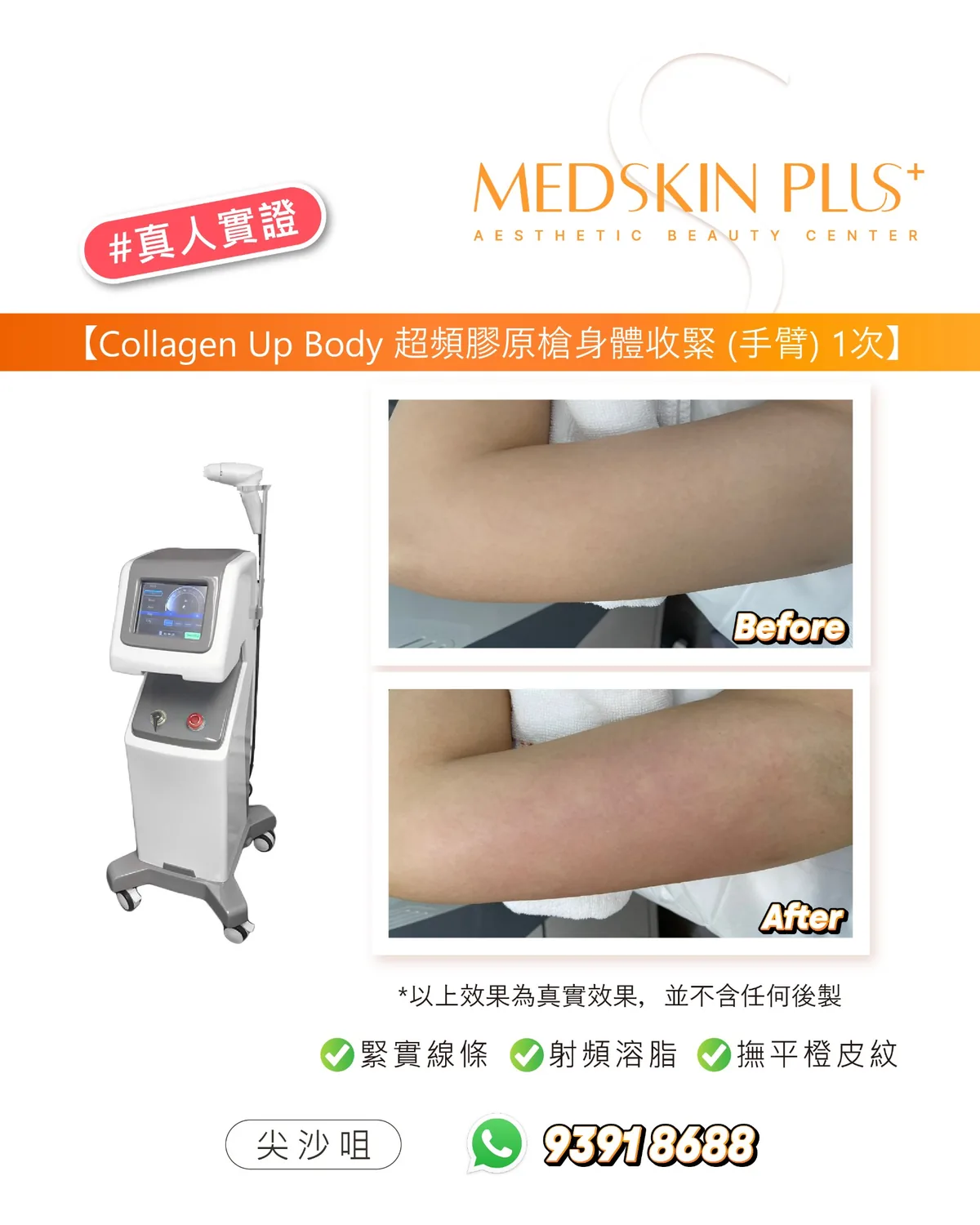 Collagen Up 真人實證宣傳圖，左方為白色膠原槍儀器，右方上下兩幅為同一客人手臂 Before 及 After 照片，下方標示緊實線條、射頻溶脂、撫平橙皮紋。
