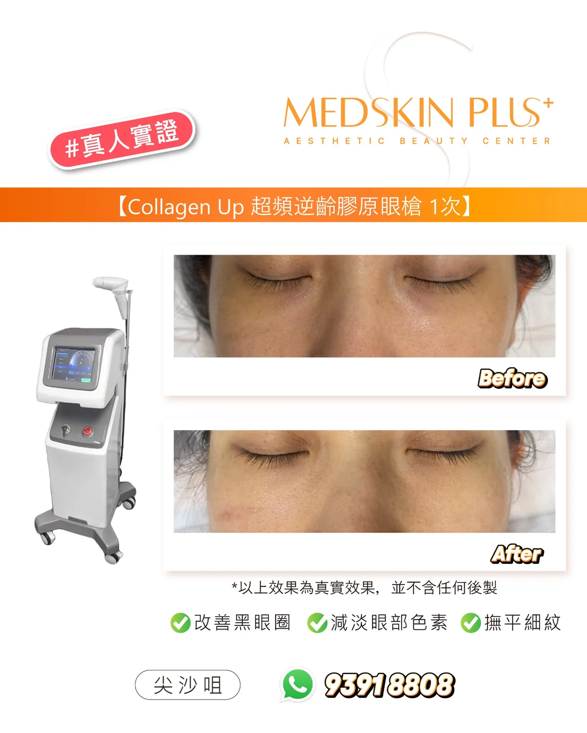 Collagen Up 超頻逆齡膠原眼槍真人實證對比圖，左側為儀器，右側上下並列同一女士閉眼狀態的眼周 Before 與 After
