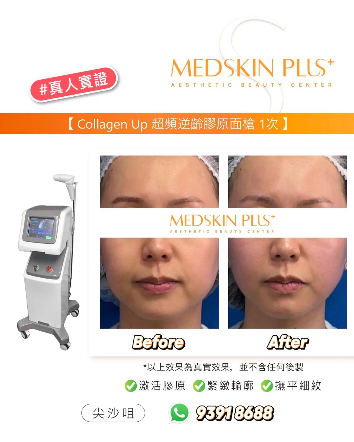 Collagen Up 超頻逆齡膠原面槍真人實證四格對比圖，左側為白色儀器，右側並列同一女士額頭與面頰的 Before 及 After