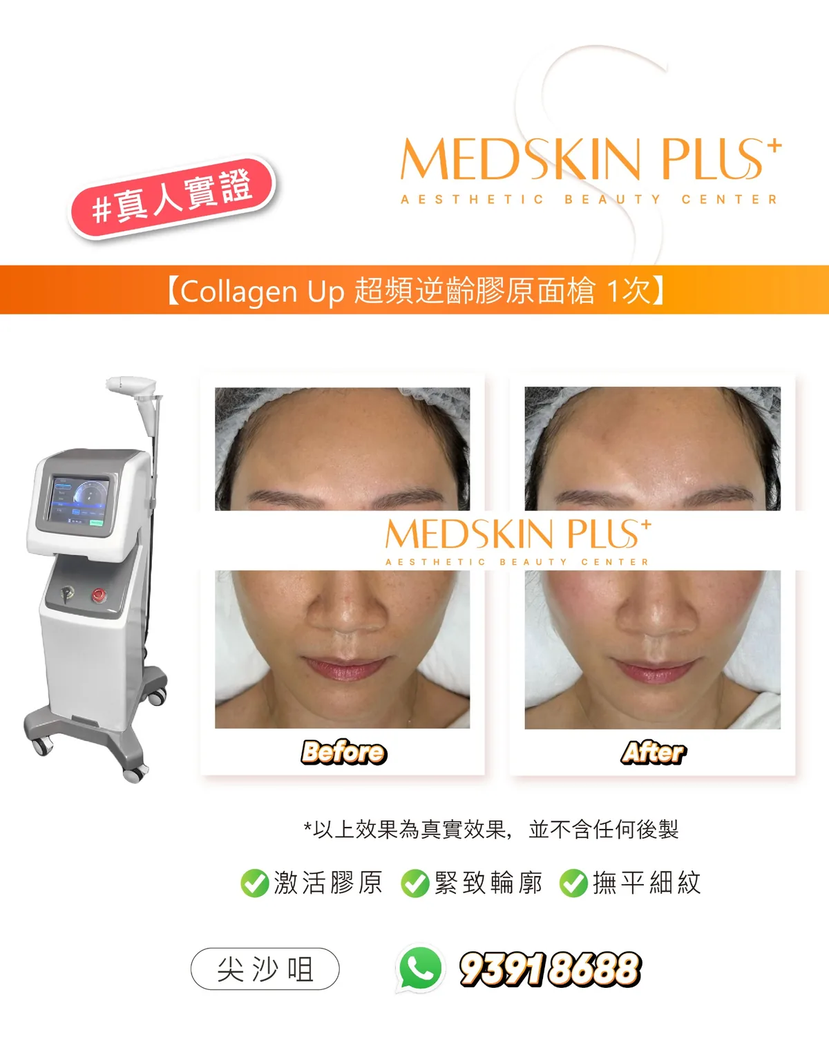 Collagen Up 超頻逆齡膠原面槍真人實證四格對比圖，左側為儀器，右側並列同一女士額頭及面部下半的療程前後