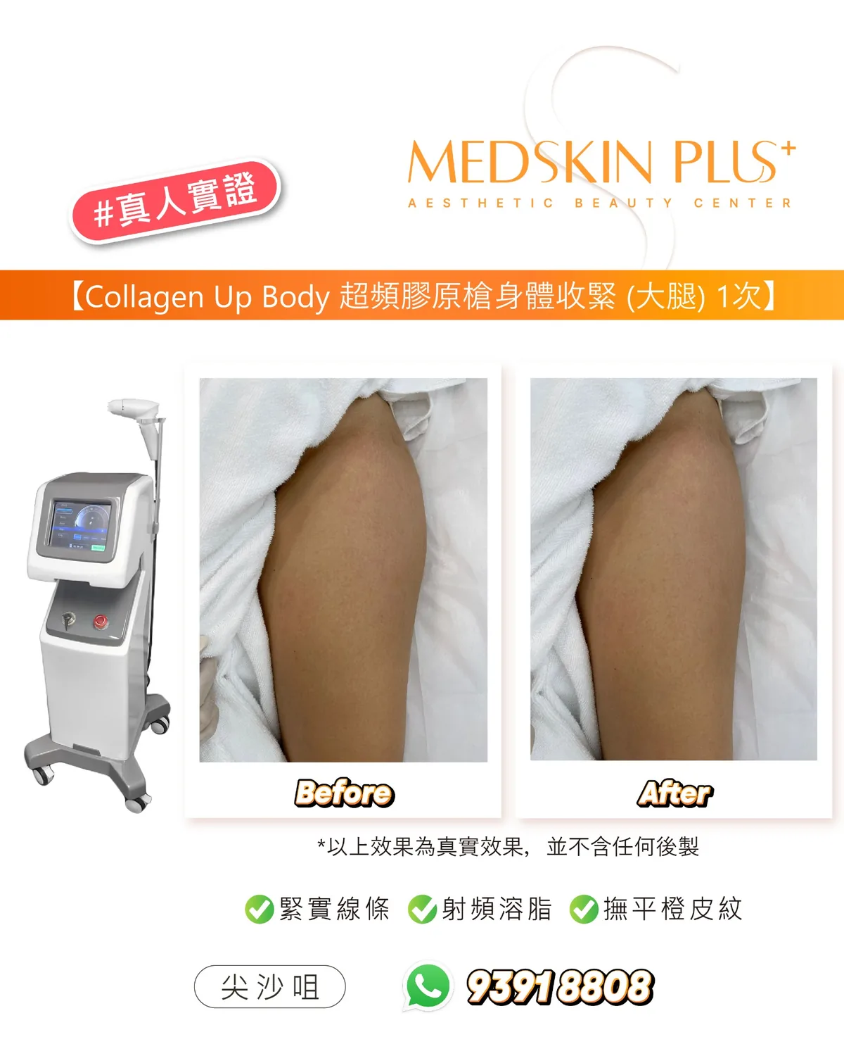左側為Collagen Up射頻儀器，右側為大腿Before與After對照，圖下標明緊實線條、射頻溶脂、撫平橙皮紋三項。