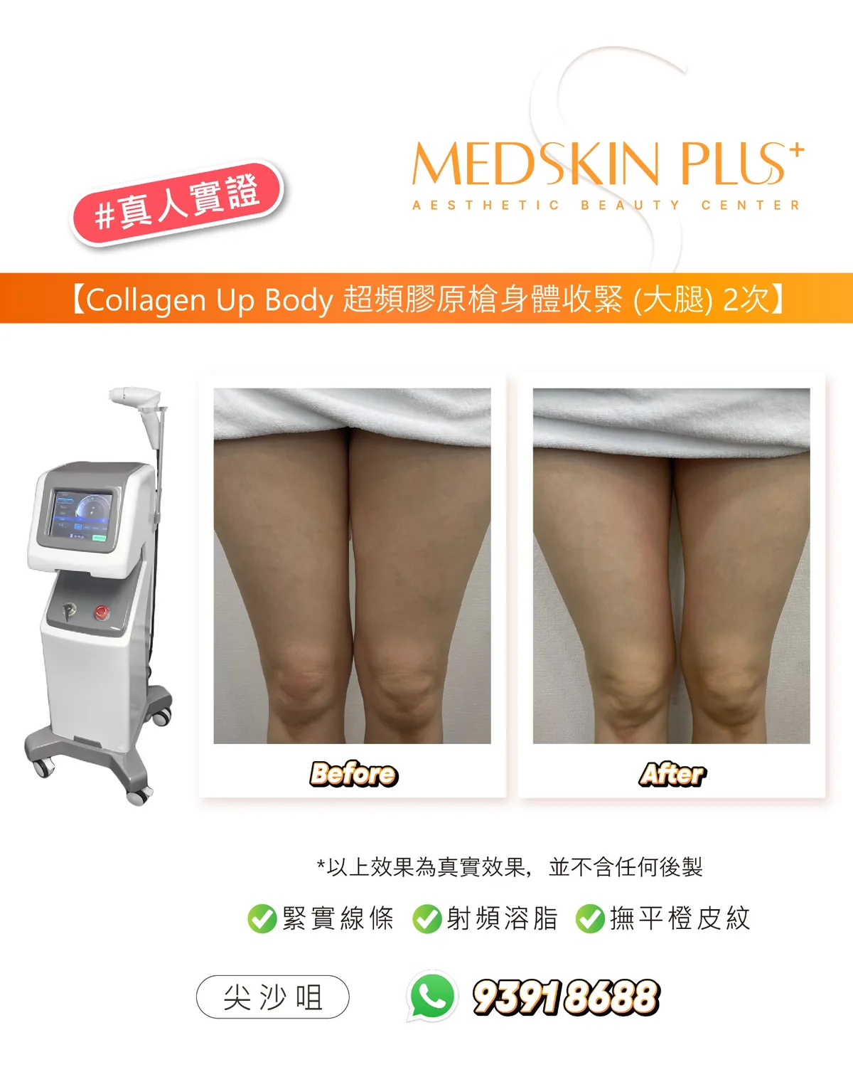 MEDSKIN PLUS+ 真人實證圖片，左側為 Collagen Up Body 超頻膠原槍儀器，右側並列大腿療程前後對比照，下方標示緊實線條、射頻溶脂及撫平橙皮紋。