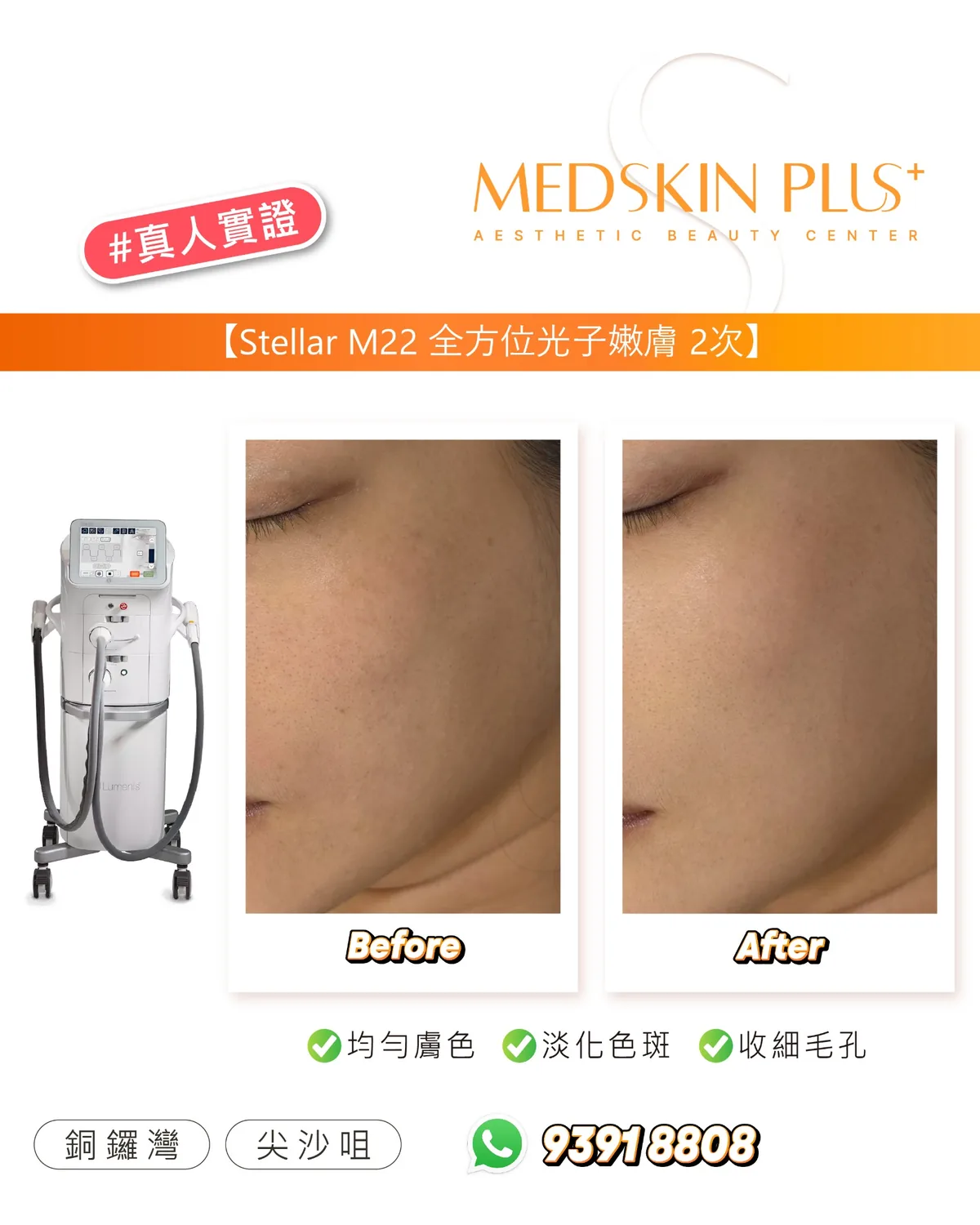 Stellar M22 真人實證宣傳圖,左方為白色儀器,中間左右兩幅為同一客人面頰 Before 及 After 照片,下方標示均勻膚色、淡化色斑、收細毛孔,並列出銅鑼灣及尖沙咀。