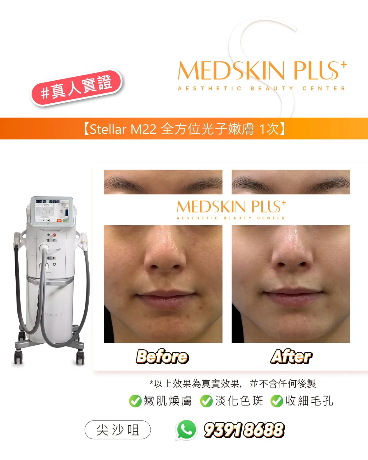 光子嫩膚真人實證圖,左方為 Lumenis Stellar M22 儀器,右方上下並列女士眼部與面頰的 Before 及 After 特寫,下方附三項以綠色剔號標示的文字。