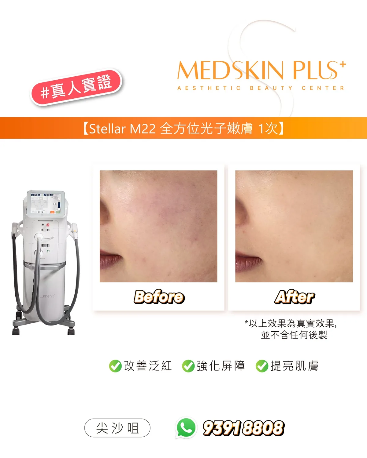 Stellar M22 光子嫩膚真人實證拼圖,左側為儀器照片,中間及右側為客人面頰療程前後對比