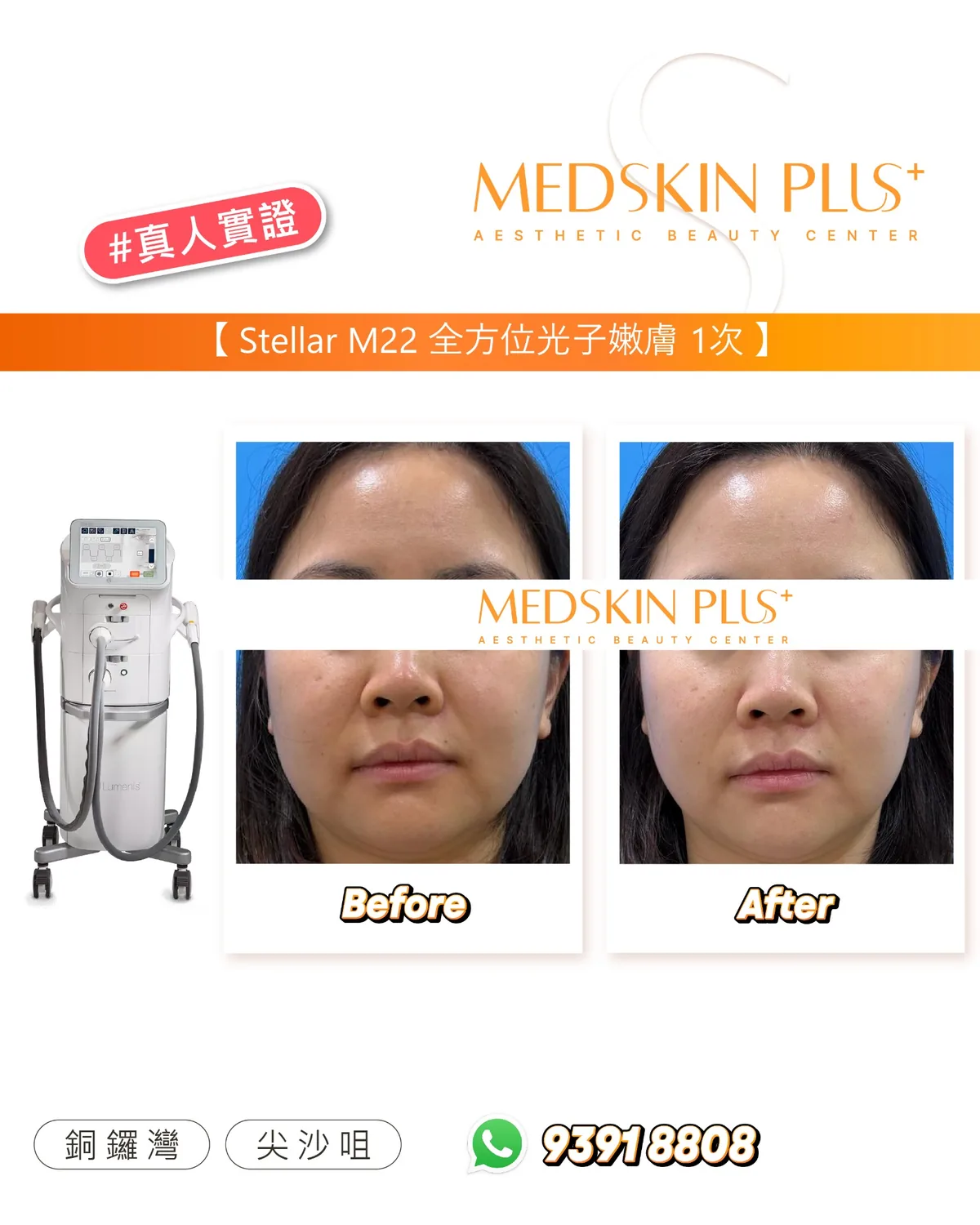左側為Stellar M22光子儀器主機,右側為同一女士正面全臉的Before與After對照照片。