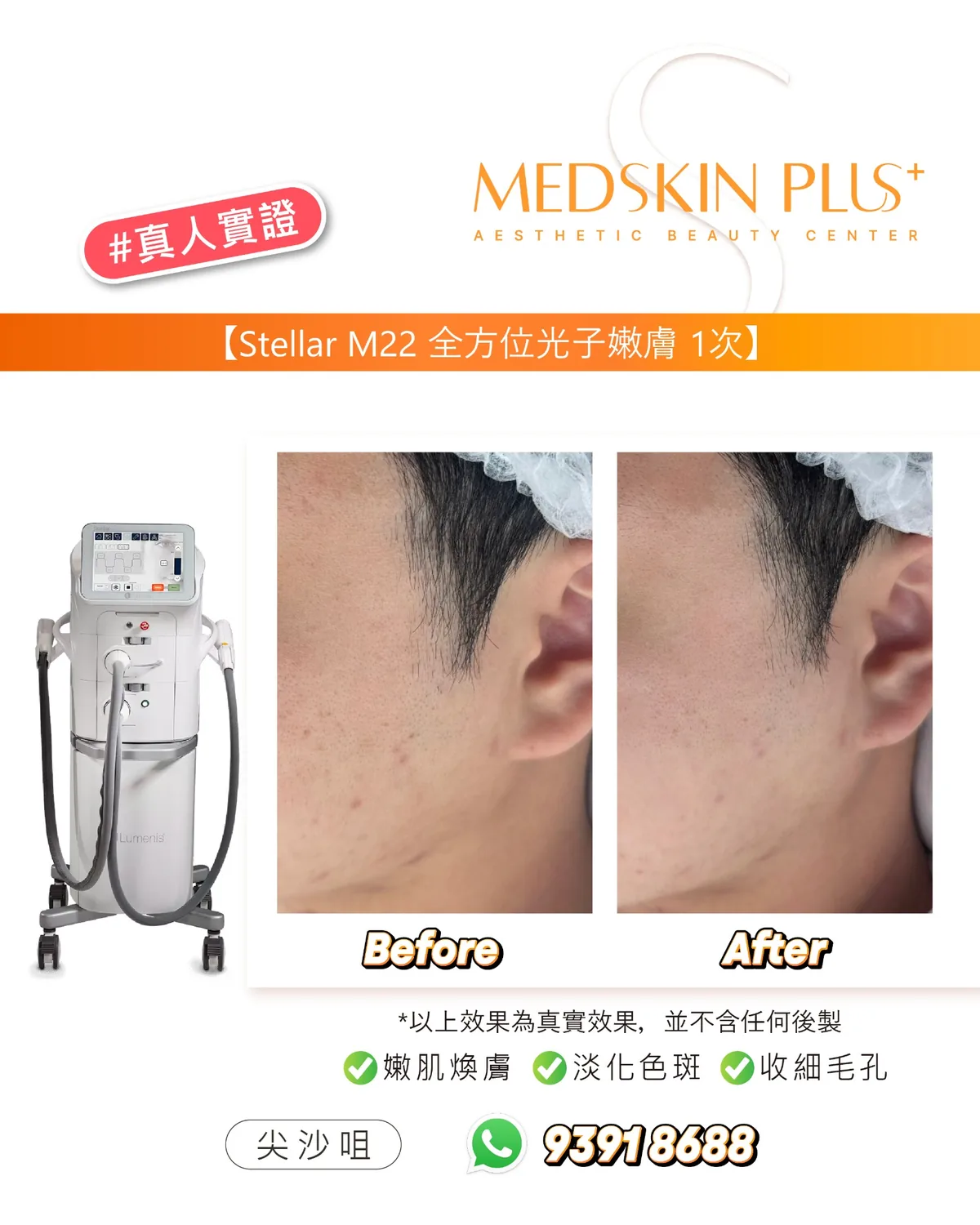 MEDSKIN PLUS+ 貼文,左側為 Lumenis Stellar M22 儀器,右側是戴白色髮網男士面頰的 Before 與 After 對比照片
