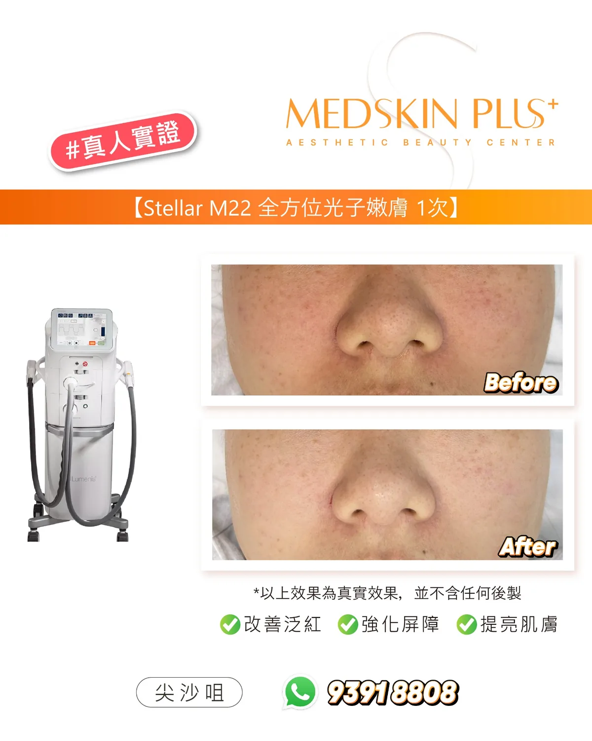 MEDSKIN PLUS+ 真人實證圖片,左側為 Stellar M22 光子嫩膚儀器,右側以上下排列方式展示鼻樑及鼻翼位置的療程前後對比照。
