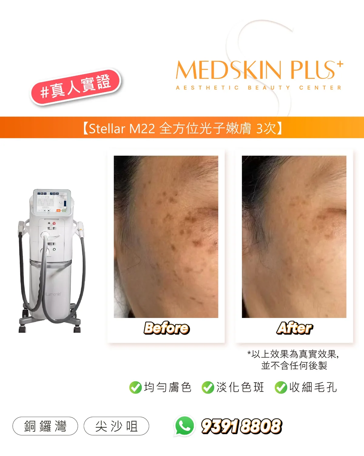 MEDSKIN PLUS+ 真人實證圖片,左側為 Stellar M22 光子嫩膚儀器,右側並列同一臉頰位置的療程前後對比照,圖中列出均勻膚色、淡化色斑、收細毛孔三項標示。