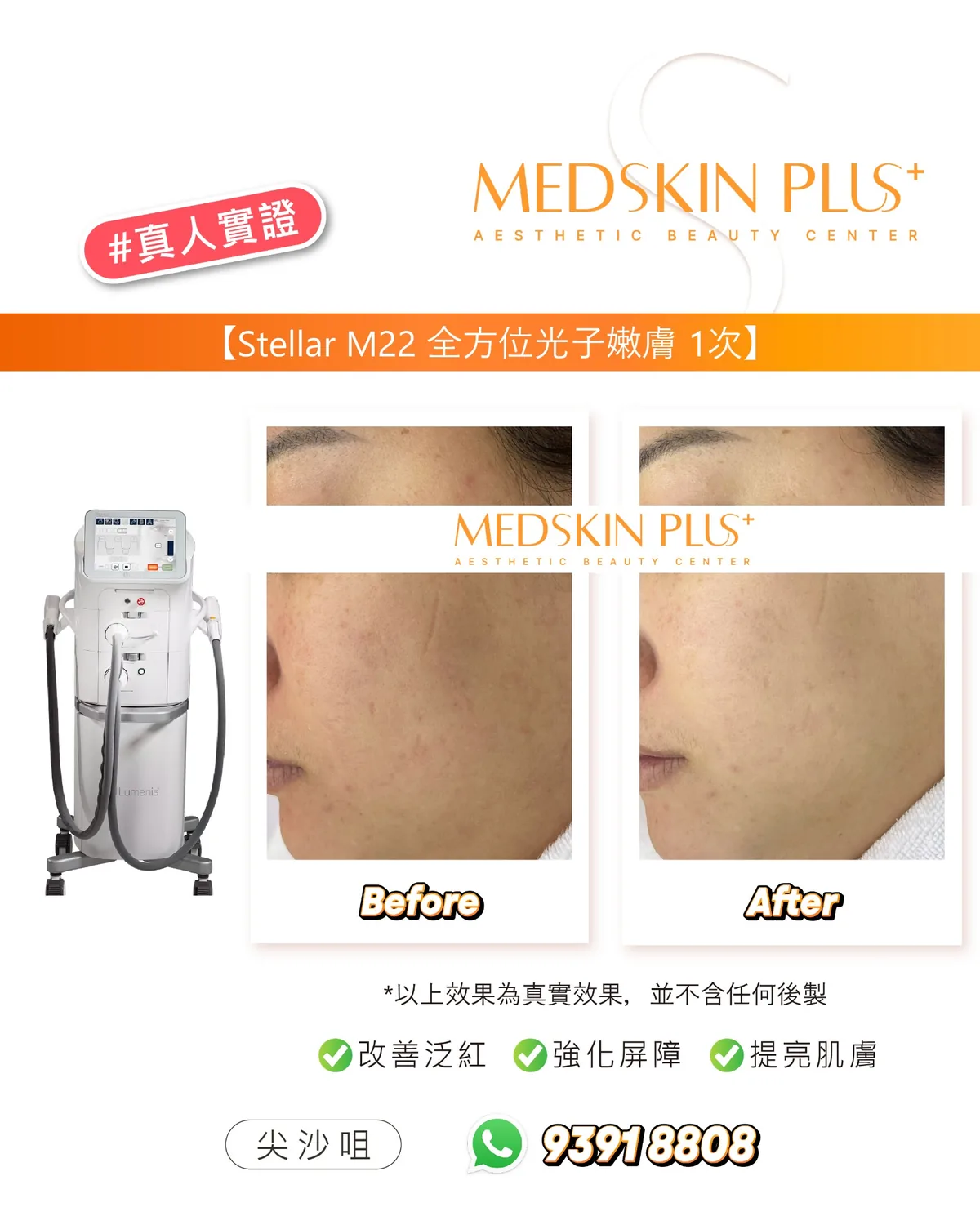 Stellar M22 全方位光子嫩膚側面真人實證對比圖,左側為白色儀器,右側四格並列同一女士面頰的 Before 與 After