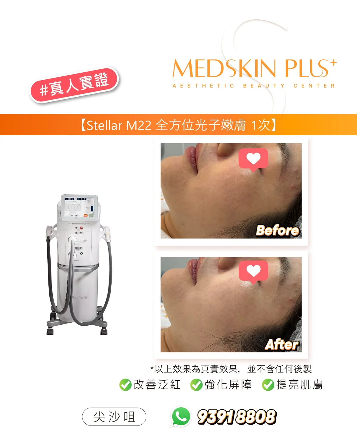 MEDSKIN PLUS+ 真人實證圖片,左側展示 Stellar M22 光子嫩膚儀器,右側為同一張側臉療程前後對比照,圖中標示改善泛紅、強化屏障及提亮肌膚。