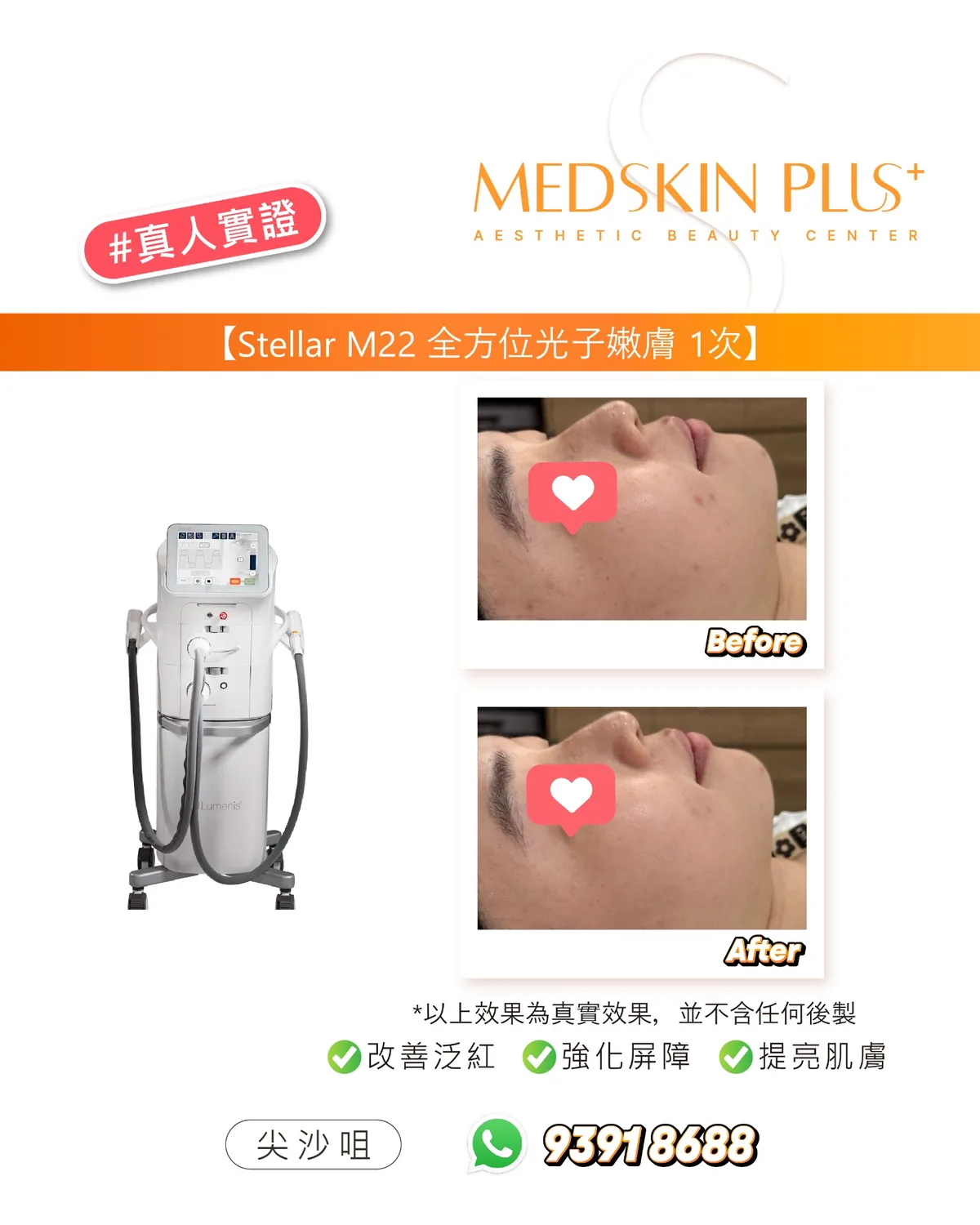 Stellar M22 光子嫩膚真人實證,左側為儀器照,右側上下兩格為客人面部側面的 Before 與 After