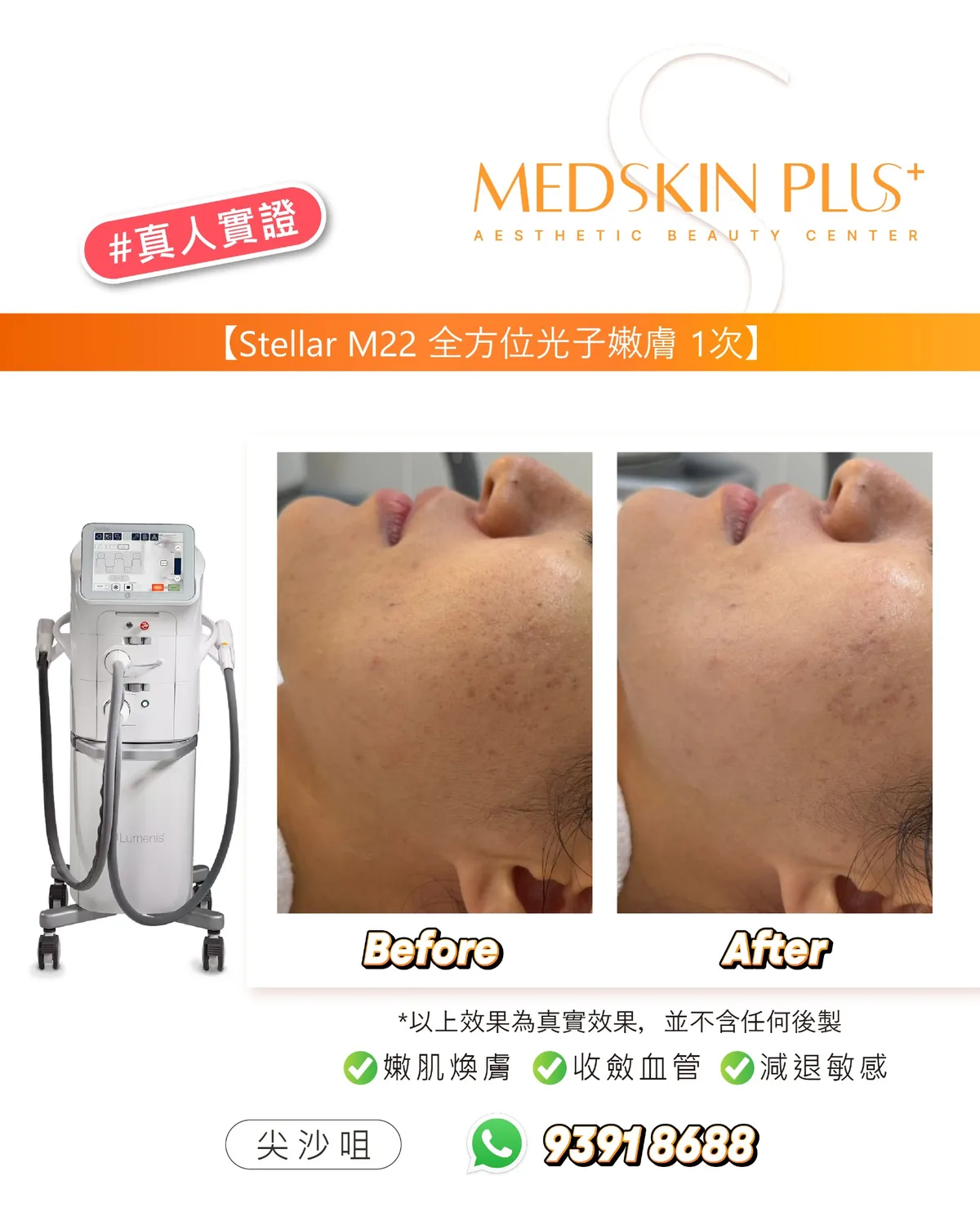 左側為Lumenis Stellar M22光子儀器,右側為同一面頰側面的Before與After對照,圖下標明嫩肌煥膚、收斂血管、減退敏感。