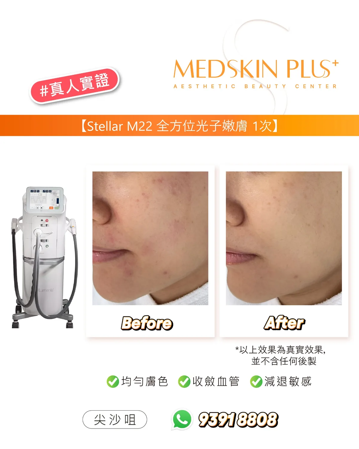 Stellar M22 真人實證宣傳圖,左方為白色儀器,中間左右兩幅為同一客人面頰 Before 及 After 照片,下方標示均勻膚色、收斂血管、減退敏感,並列有電話號碼。