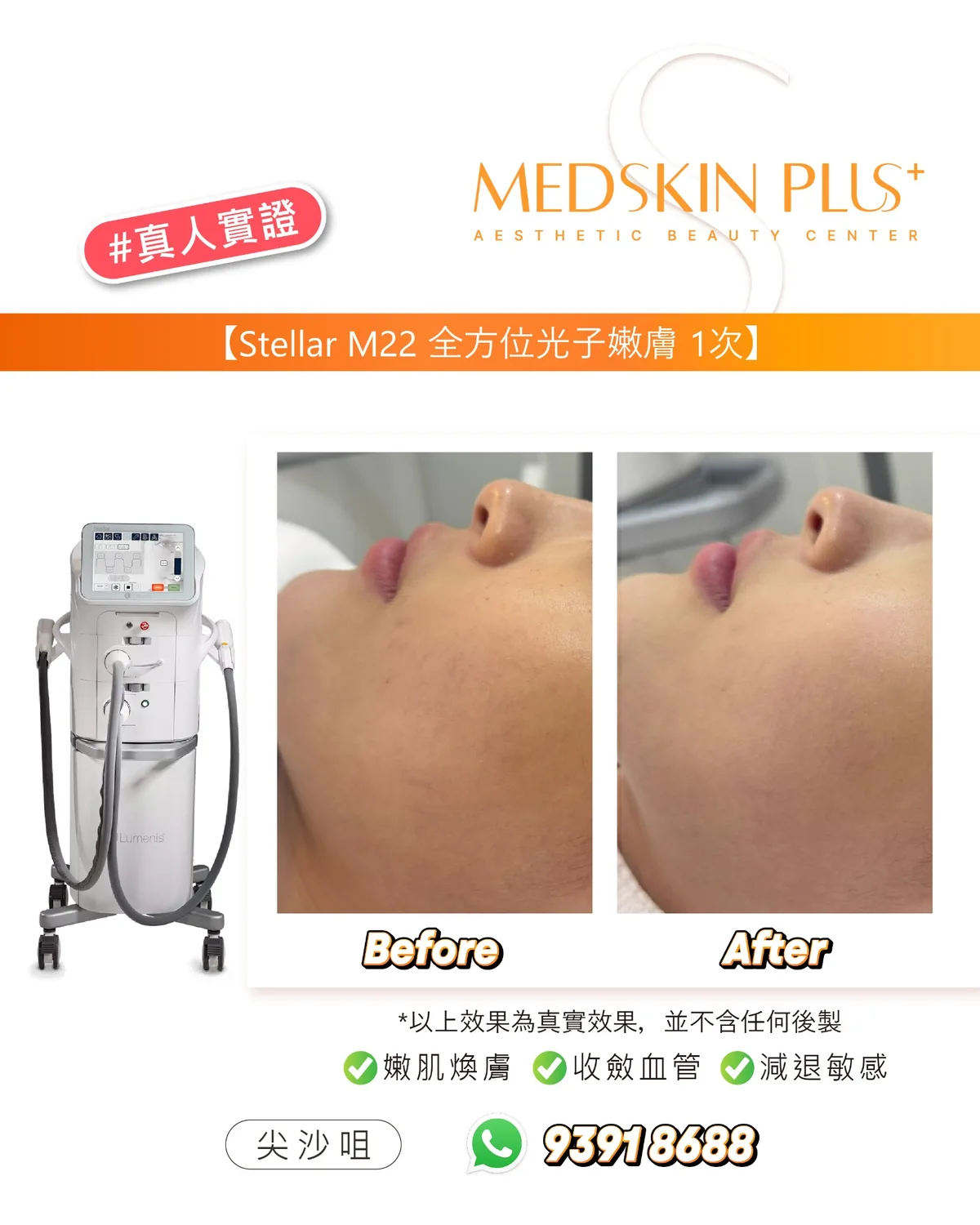 Stellar M22 真人實證宣傳圖,左方為白色儀器,中間左右兩幅為同一客人下巴與頸部側面 Before 及 After 照片,下方標示嫩肌煥膚、收斂血管及減退敏感。