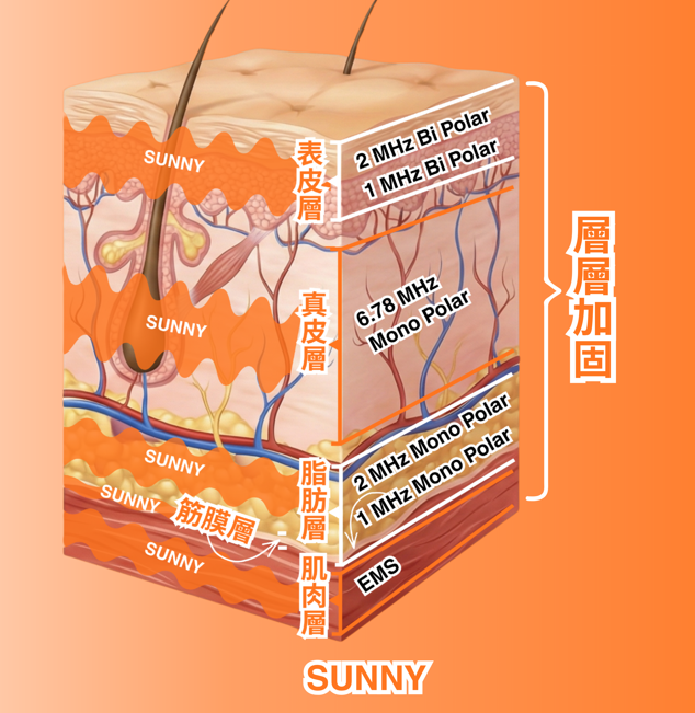 SUNNY RF 射頻技術示意圖，以立體皮膚斷層標示表皮層、真皮層、脂肪層、筋膜層及肌肉層，右方列出各層對應射頻頻率與 EMS，旁標示層層加固