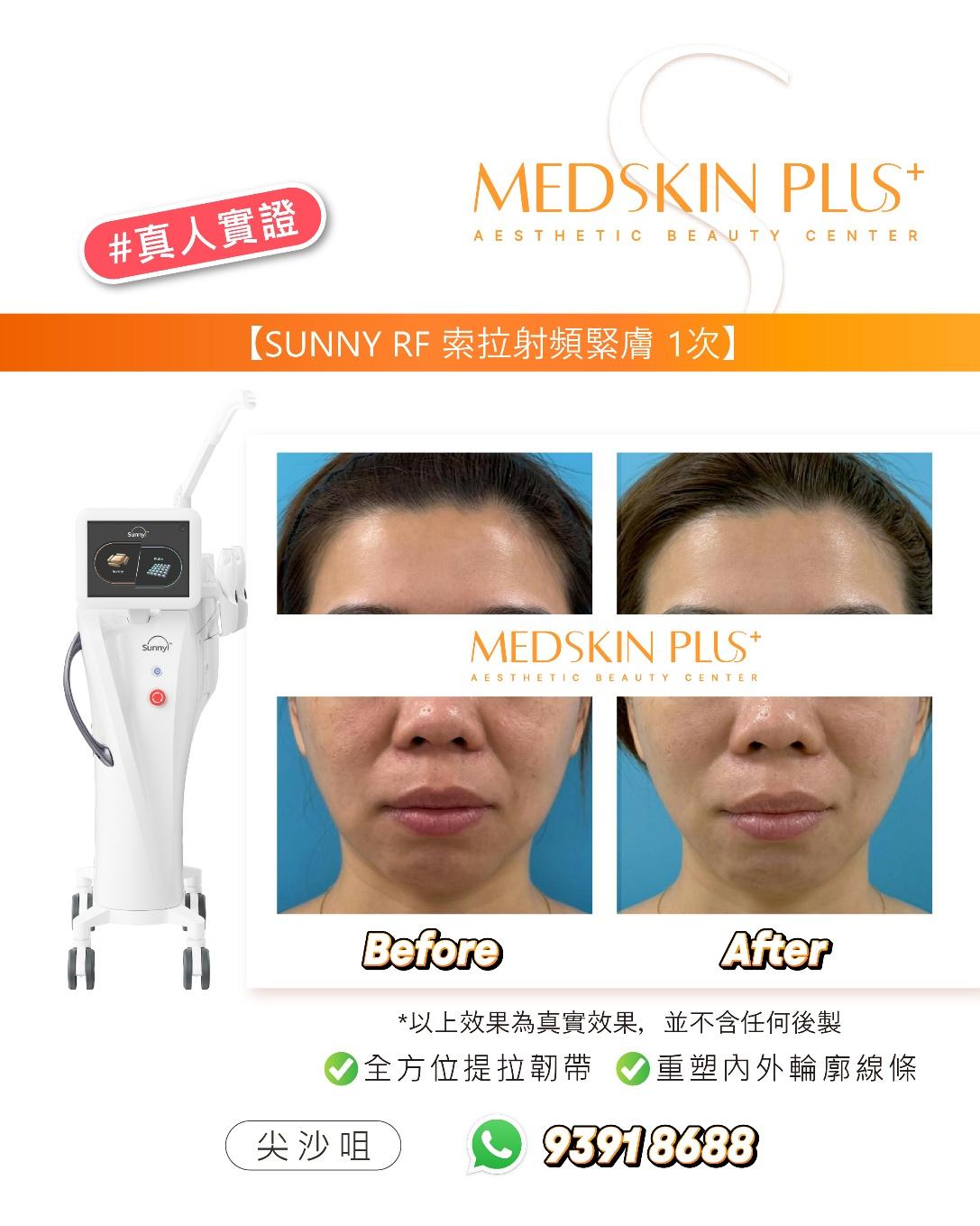 MEDSKIN PLUS+分享的SUNNY RF索拉射頻緊膚療程前後對比圖，左方為白色射頻儀器，右方上下分別為女士額頭及下半面部的Before與After正面特寫，背景為藍色。
