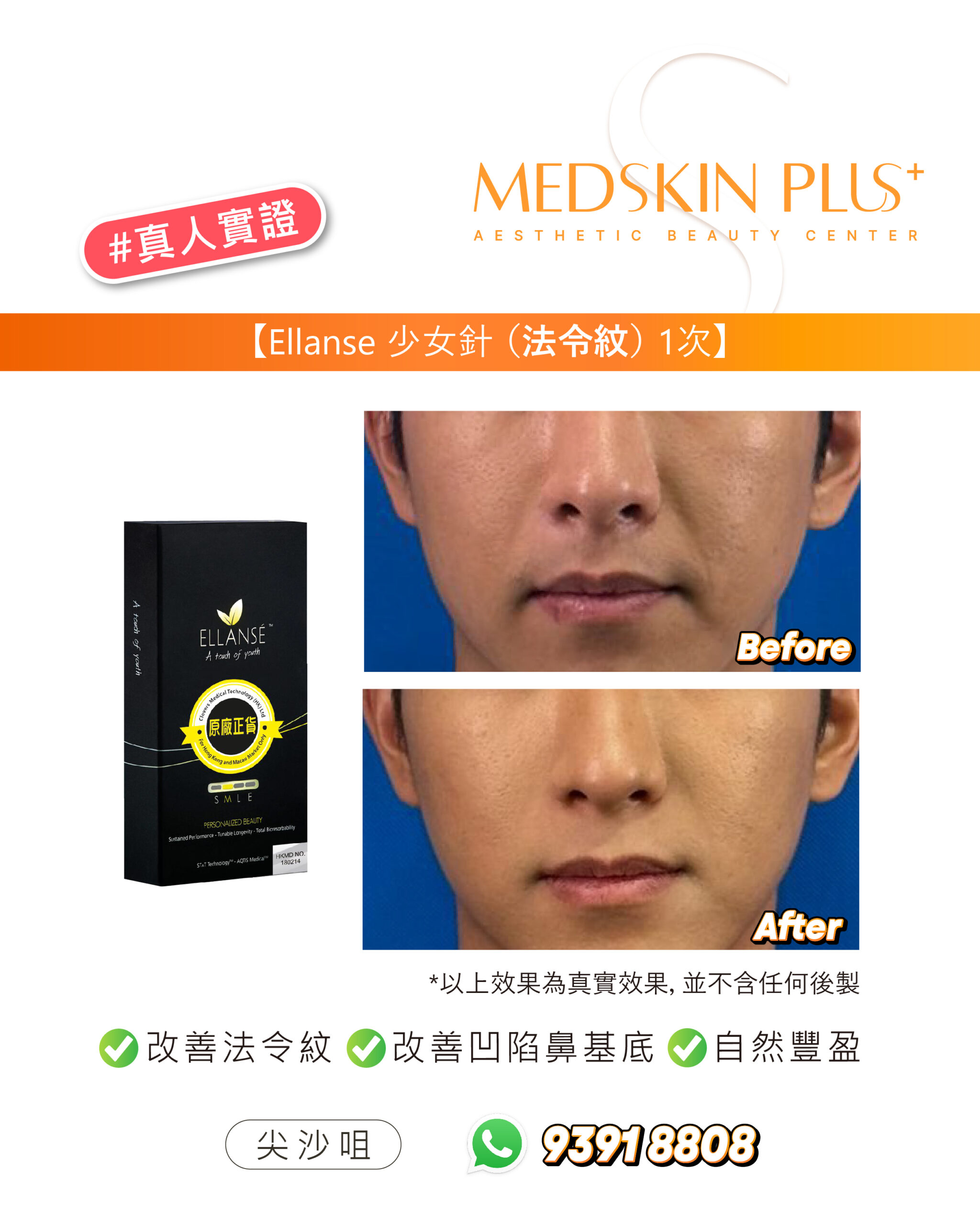 左側是黑色 ELLANSE 少女針外盒，右側為下半面真實前後對比照，聚焦鼻翼兩側至嘴角位置，下方列有改善法令紋等字句。