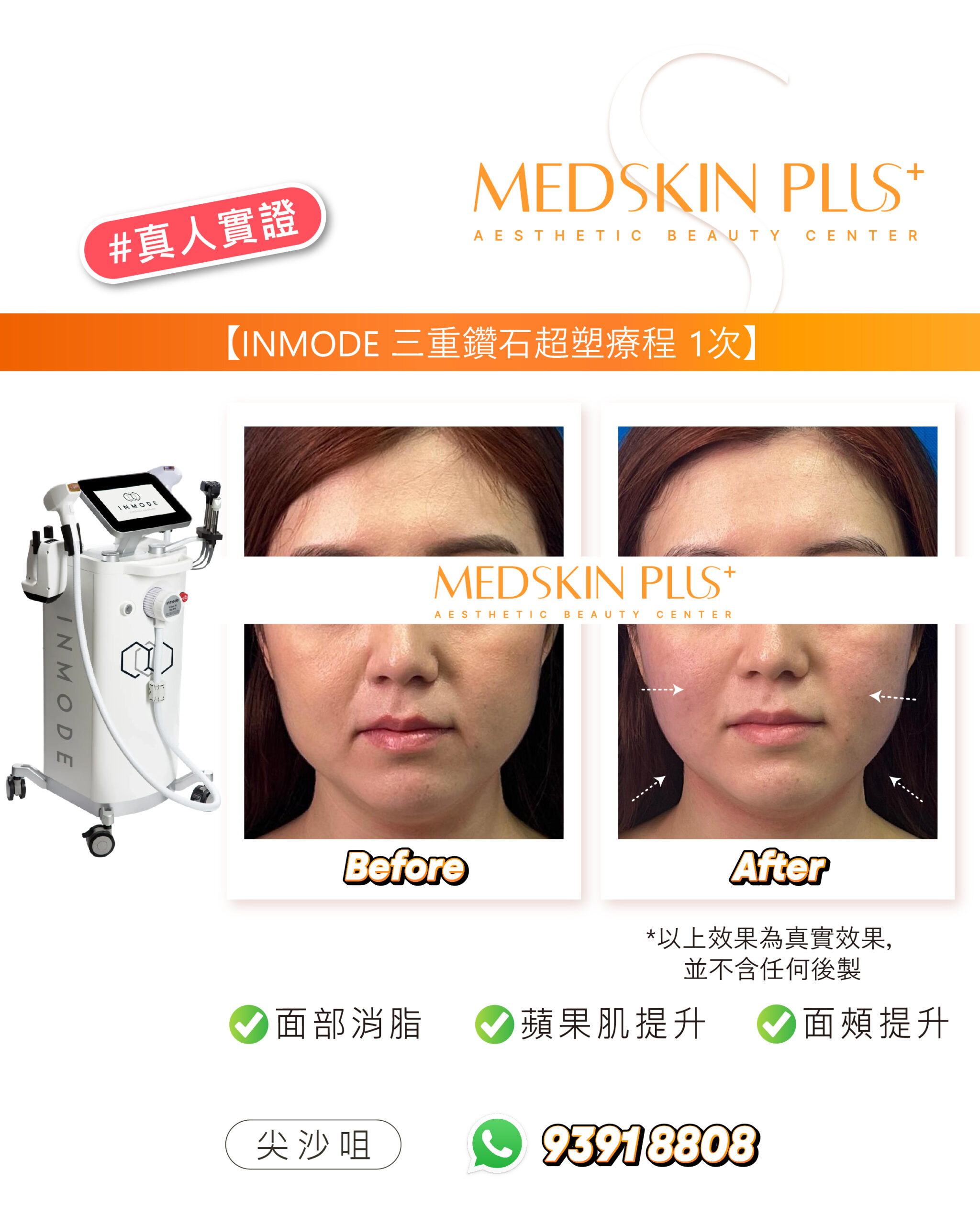 左側為 INMODE 儀器，右方為長髮女士額頭及下半臉的 Before 與 After 相片，並以虛線箭頭標示太陽穴與面頰位置。