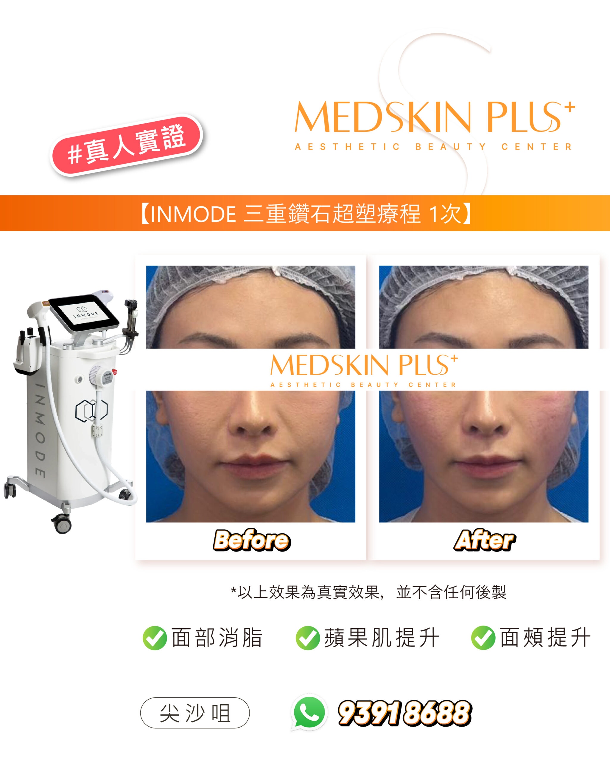 左側為白色 INMODE 儀器，右方為戴髮網女士在藍色背景下的額頭及下半臉 Before 與 After 相片。