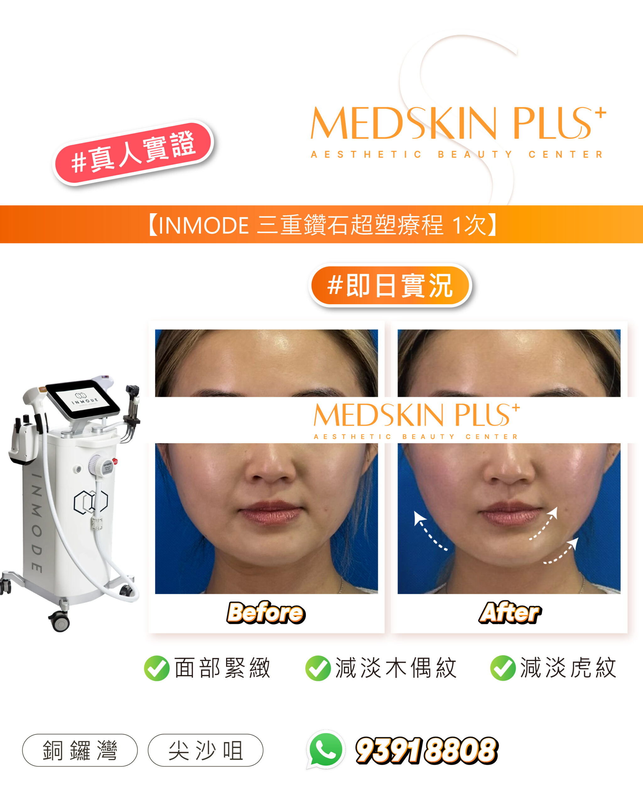 女士面部正面特寫的療程前後對比：左格標 Before、右格標 After，藍色背景，右格以白色虛線箭頭指示下顎位置，左側為白色 INMODE 儀器。