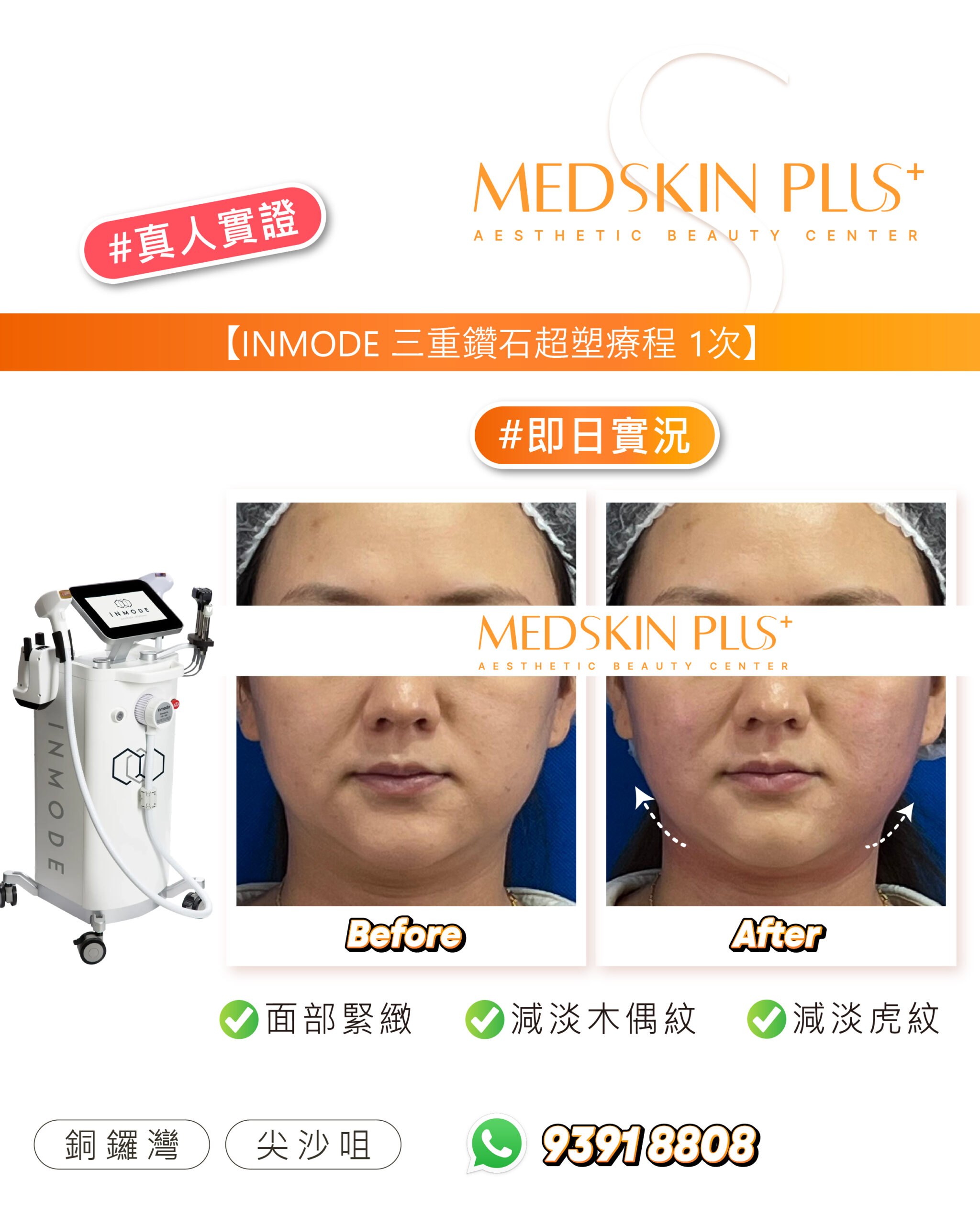 女士面部正面特寫的療程前後對比：左格標 Before、右格標 After，藍色背景配白色護理帽，左側為白色 INMODE 儀器，頂部橙色標題寫有療程名稱與次數。