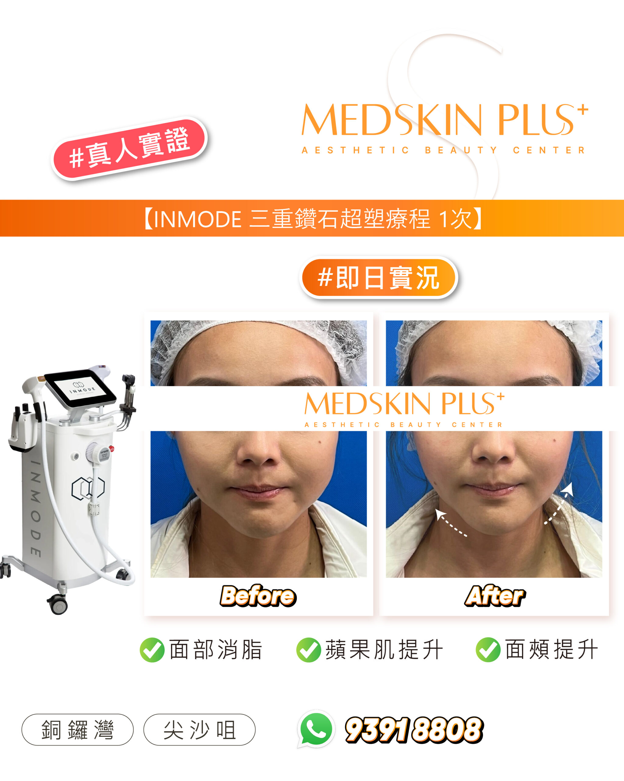 左側為白色 INMODE 儀器機身，右方上下排列同一女士額頭及下半臉的 Before 與 After 相片，並以箭頭標示面頰位置，屬診所真人實證圖片。