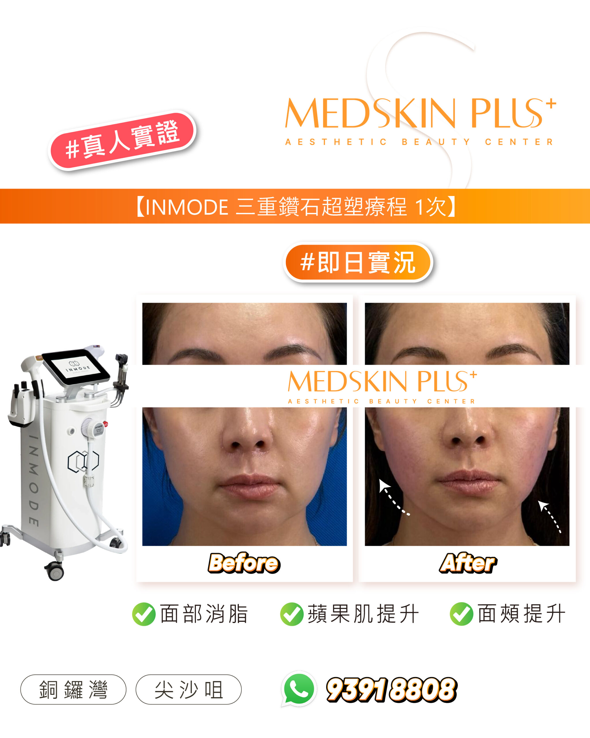 女士面部正面特寫的療程前後對比：左格標 Before、右格標 After，深藍色背景，右格以兩條白色虛線箭頭指出下顎線位置，左側為白色 INMODE 儀器。