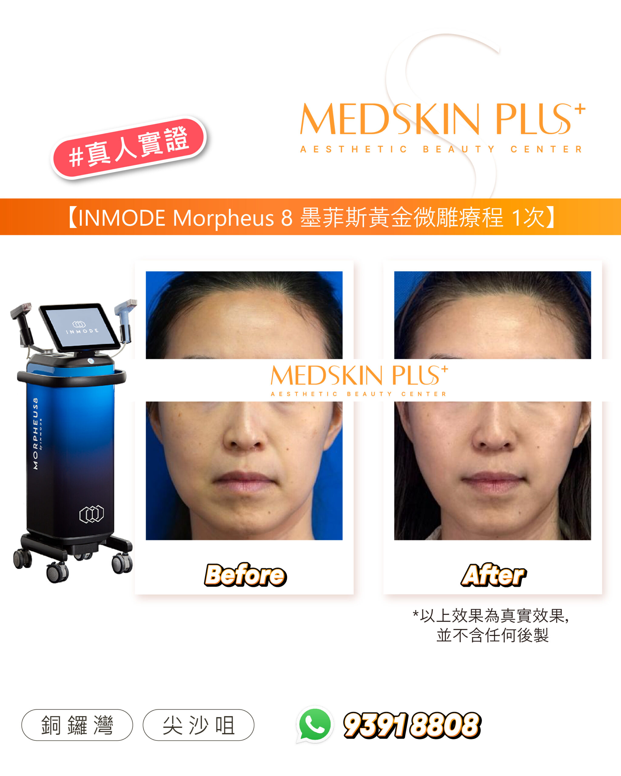 女士面部正面特寫的療程前後對比：左格標 Before、右格標 After，藍色背景，左側為黑色 Morpheus8 儀器，橙色標題寫有療程名稱與次數。