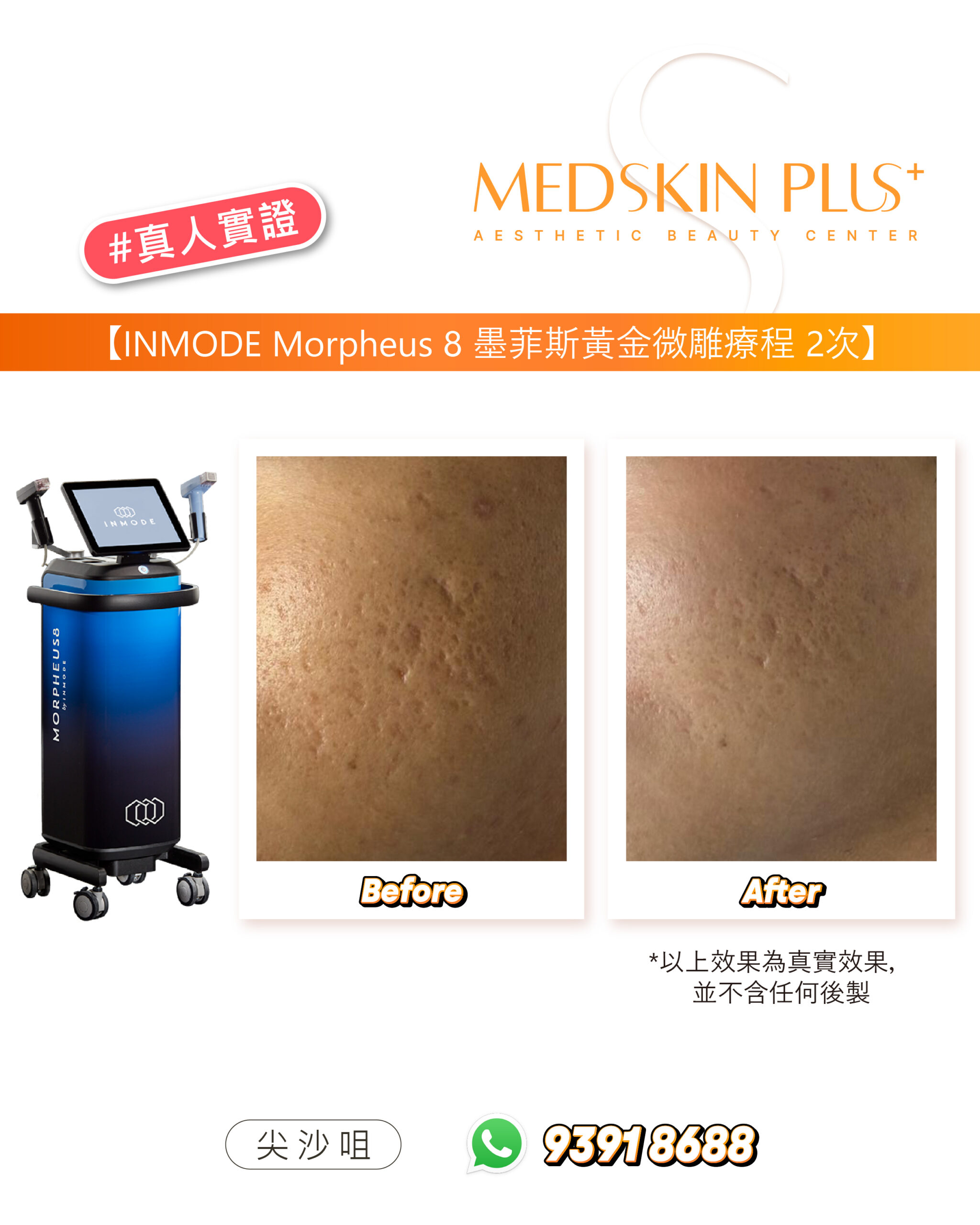 左側是 INMODE Morpheus 8 儀器，右側兩張近拍照片顯示面頰皮膚紋理與凹凸感的前後對比，圖下有尖沙咀分店資料。