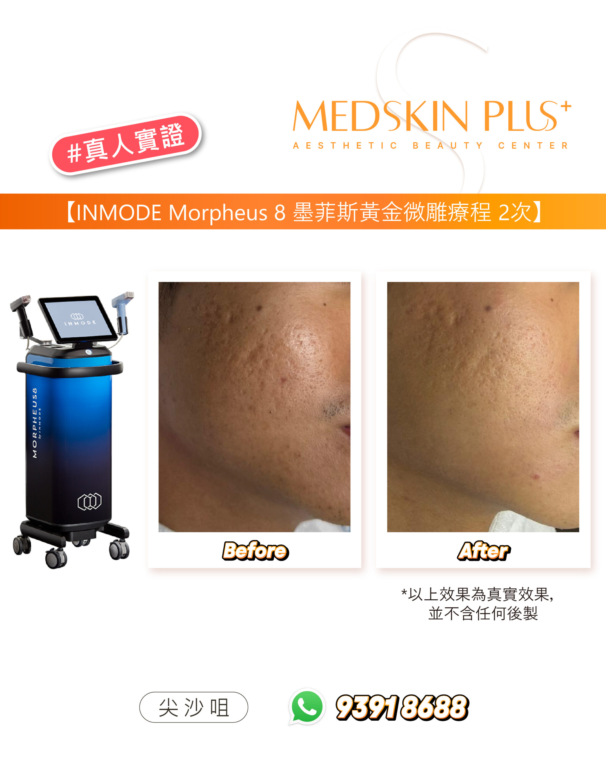 左側是黑藍色 INMODE Morpheus 8 儀器，右側為面頰皮膚紋理的前後對比近拍，下方註明效果為真實效果，並列有尖沙咀分店資料。
