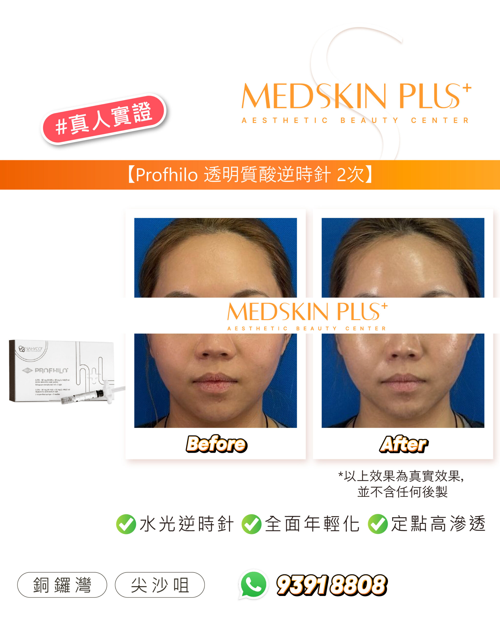左側為 PROFhilo 包裝盒與針筒，右方為同一女士在藍色背景下的額頭及下半臉 Before 與 After 相片。