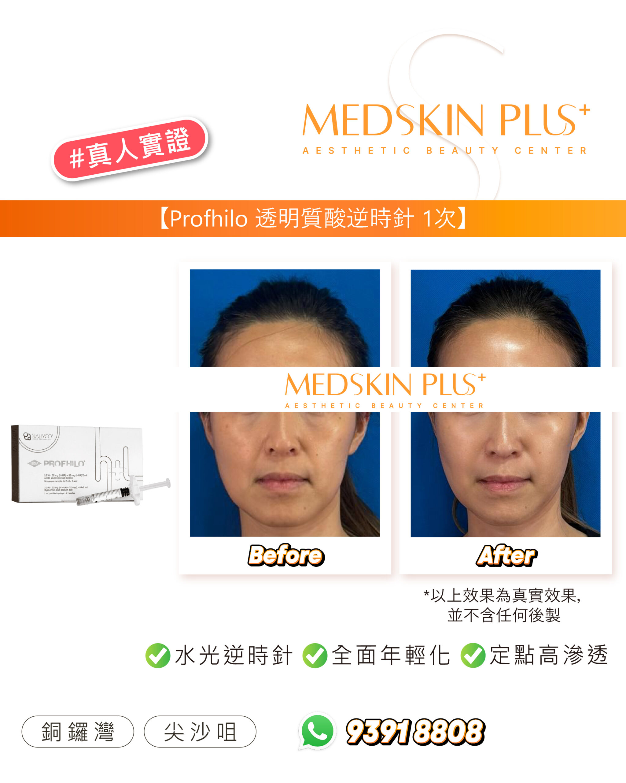 MEDSKIN PLUS+ #真人實證圖片，顯示 Profhilo 透明質酸逆時針療程 1 次後的額頭及全臉 Before 與 After 對比照，並有產品盒與注射器。