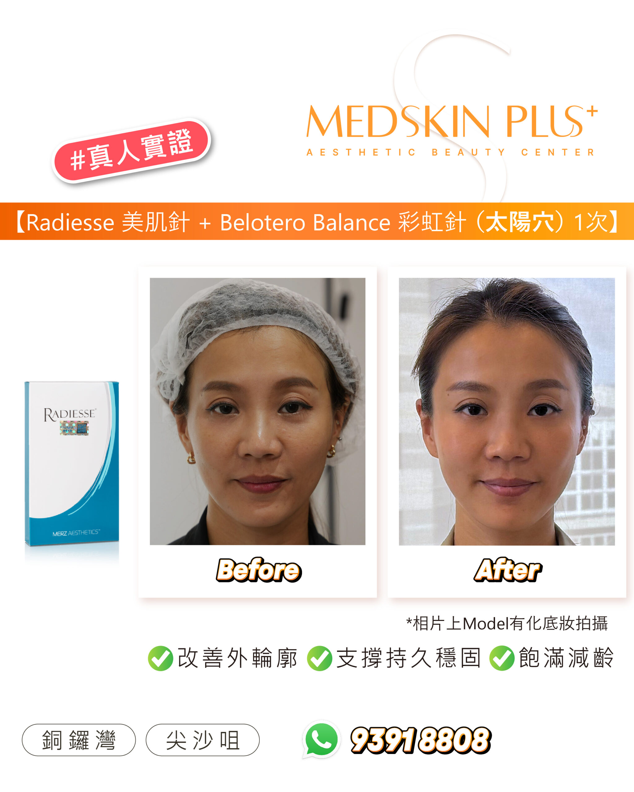 左側為 RADIESSE 產品盒，右方為同一女士戴髮網及放下頭髮的 Before 與 After 相片，屬診所真人實證圖片。