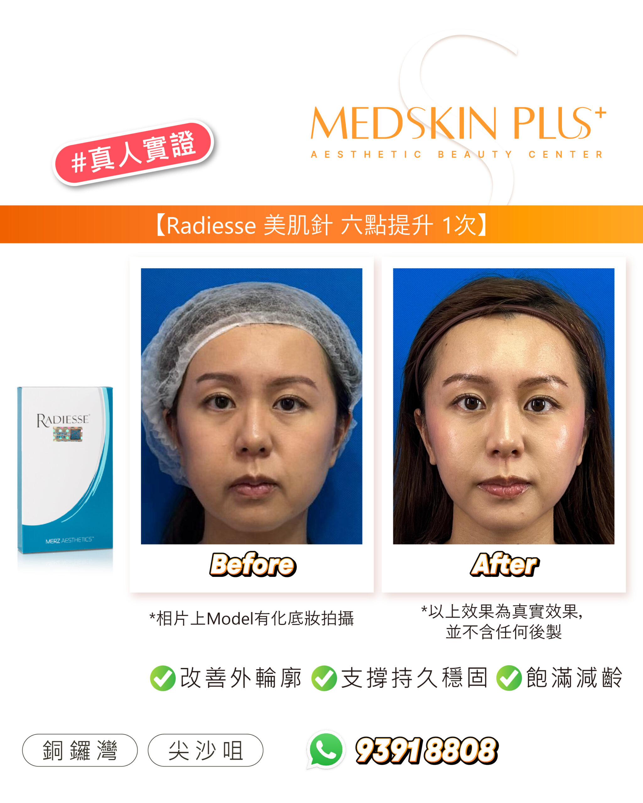 Radiesse 美肌針六點提升1次的真人對比圖，左為療程前正面照，右為療程後正面照，旁有 RADIESSE 產品盒，下方標示改善外輪廓、支撐持久穩固及飽滿減齡