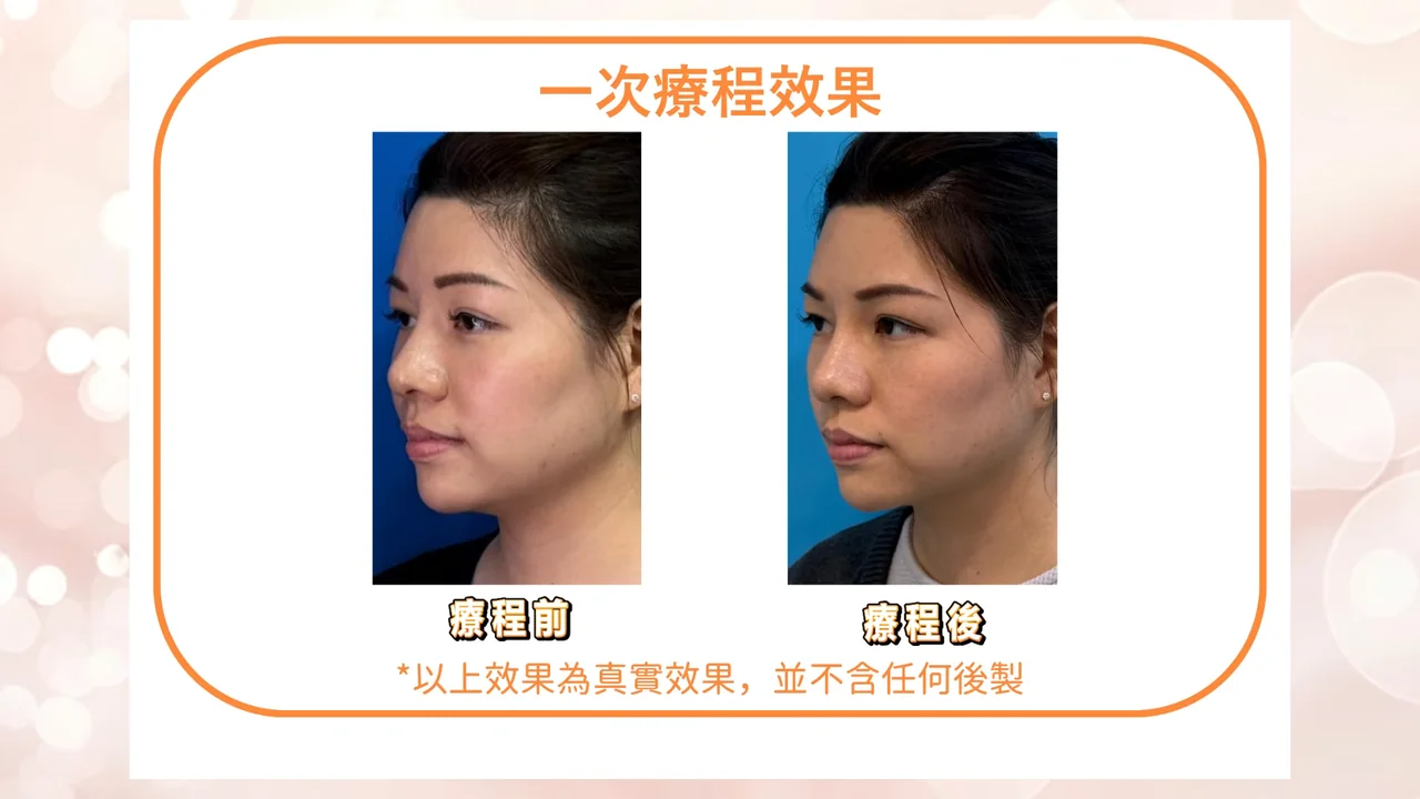 影片展示一次療程前後對比,療程後下顎線條較清晰