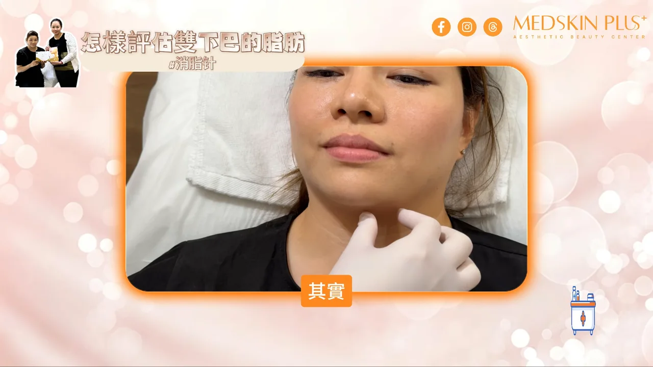 醫生以手指捏起雙下巴位置,評估是否屬可以注射的皮下脂肪