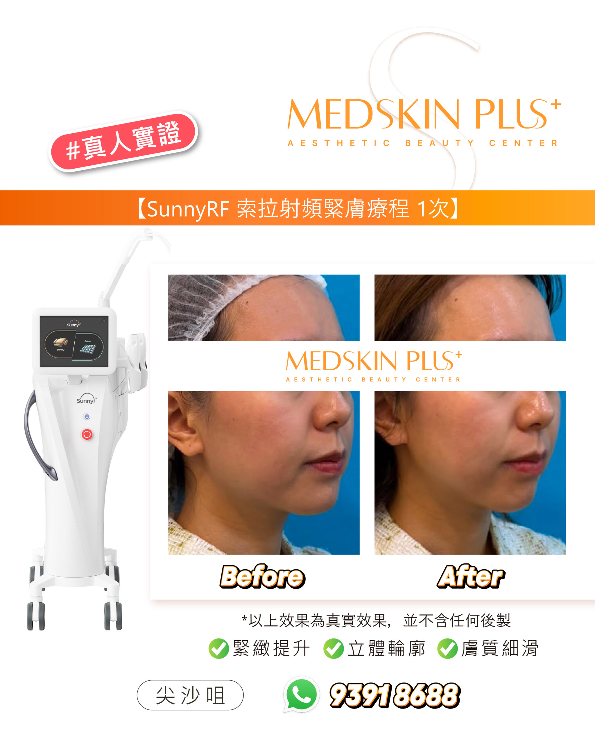 MEDSKIN PLUS+ #真人實證圖片，展示 SunnyRF 索拉射頻緊膚療程 1 次後的 Before 與 After 額側及下顎側面輪廓對比，左側為 SunnyRF 儀器。