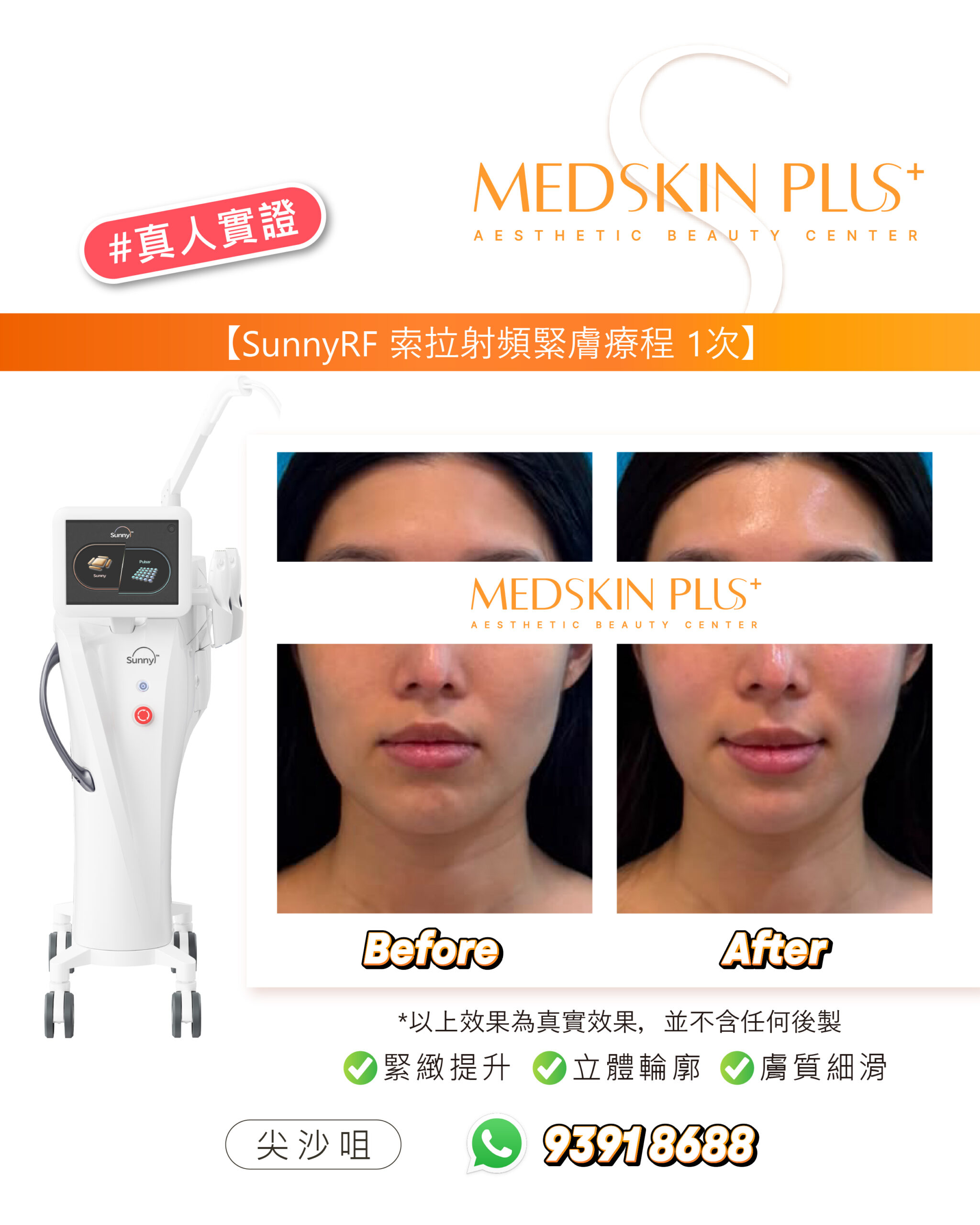 左側是白色索拉射頻儀器，右側為額頭與下半面的四格前後對比照，中央印有 MEDSKIN PLUS+ 標誌，下方列出緊緻提升等字句。