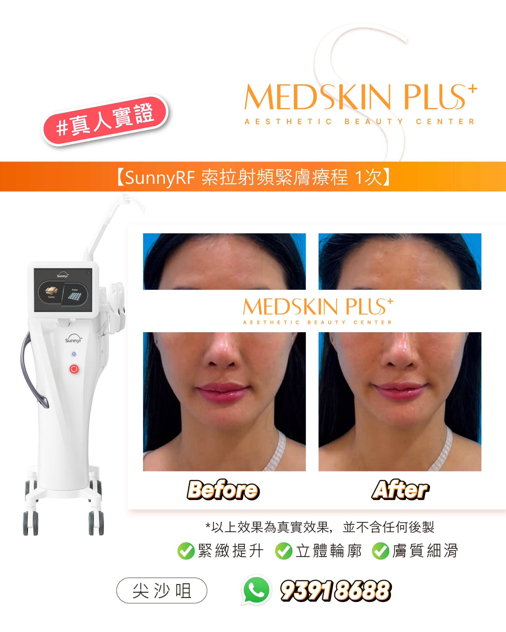 MEDSKIN PLUS+ #真人實證圖片，展示 SunnyRF 索拉射頻緊膚療程後額頭及全臉正面的 Before 與 After 對比，左側為 SunnyRF 射頻儀器。