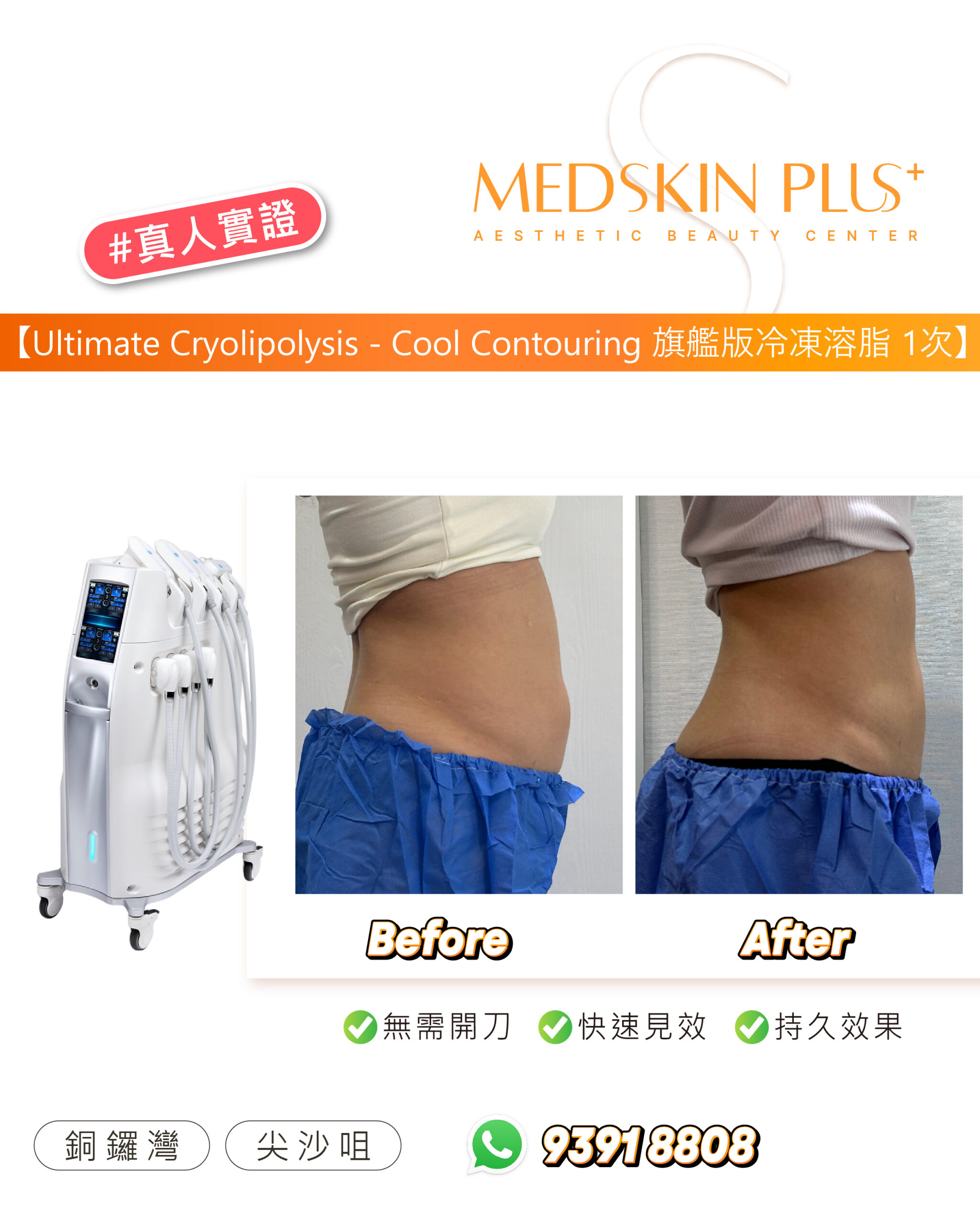 左側為冷凍溶脂儀器，右方為同一人士腰腹的 Before 與 After 相片，示範者身穿藍色紙褲，背景為白色牆身。