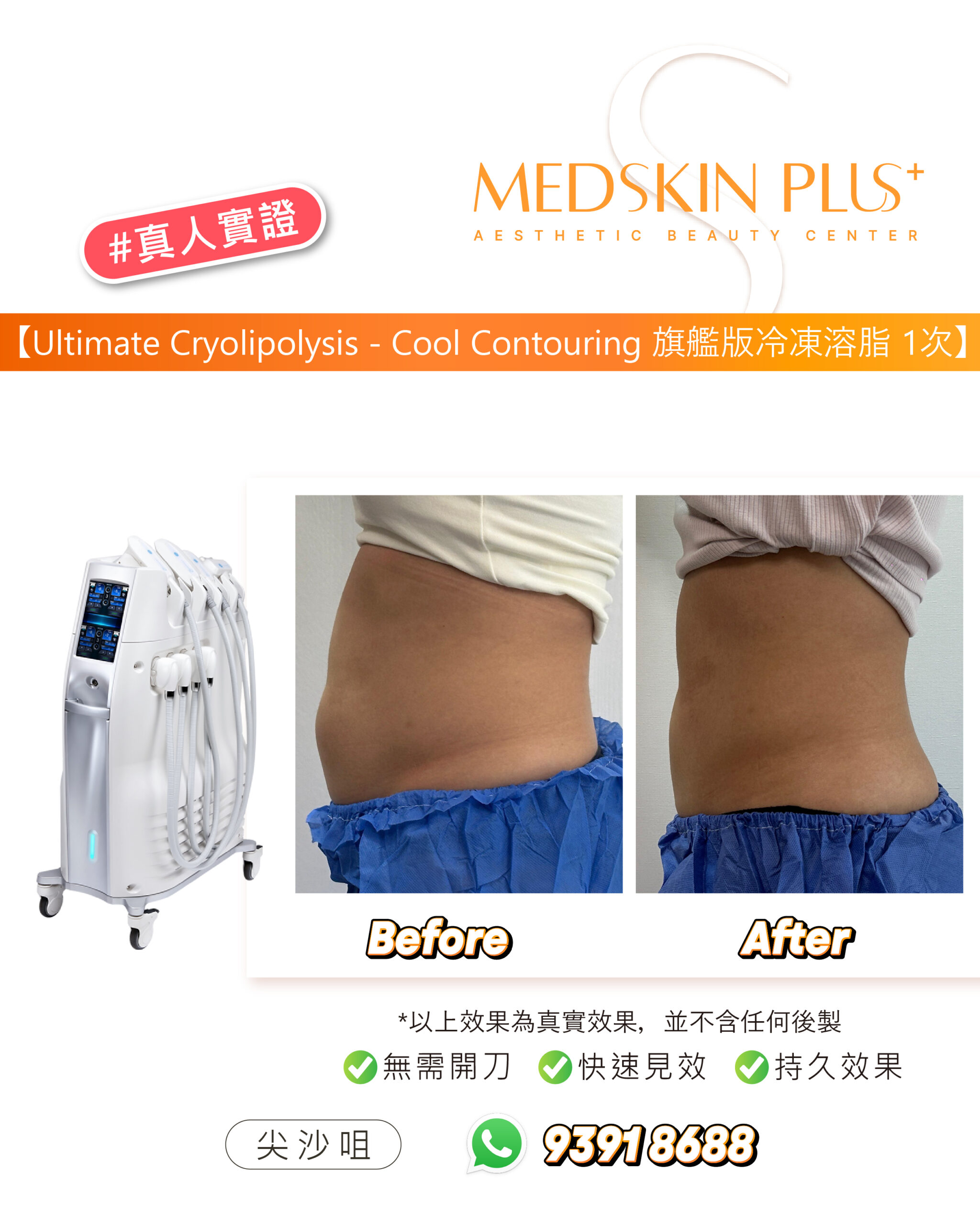 左側為冷凍溶脂儀器，右方為同一人士腰腹的 Before 與 After 相片，下方註明效果為真實效果、不含任何後製。