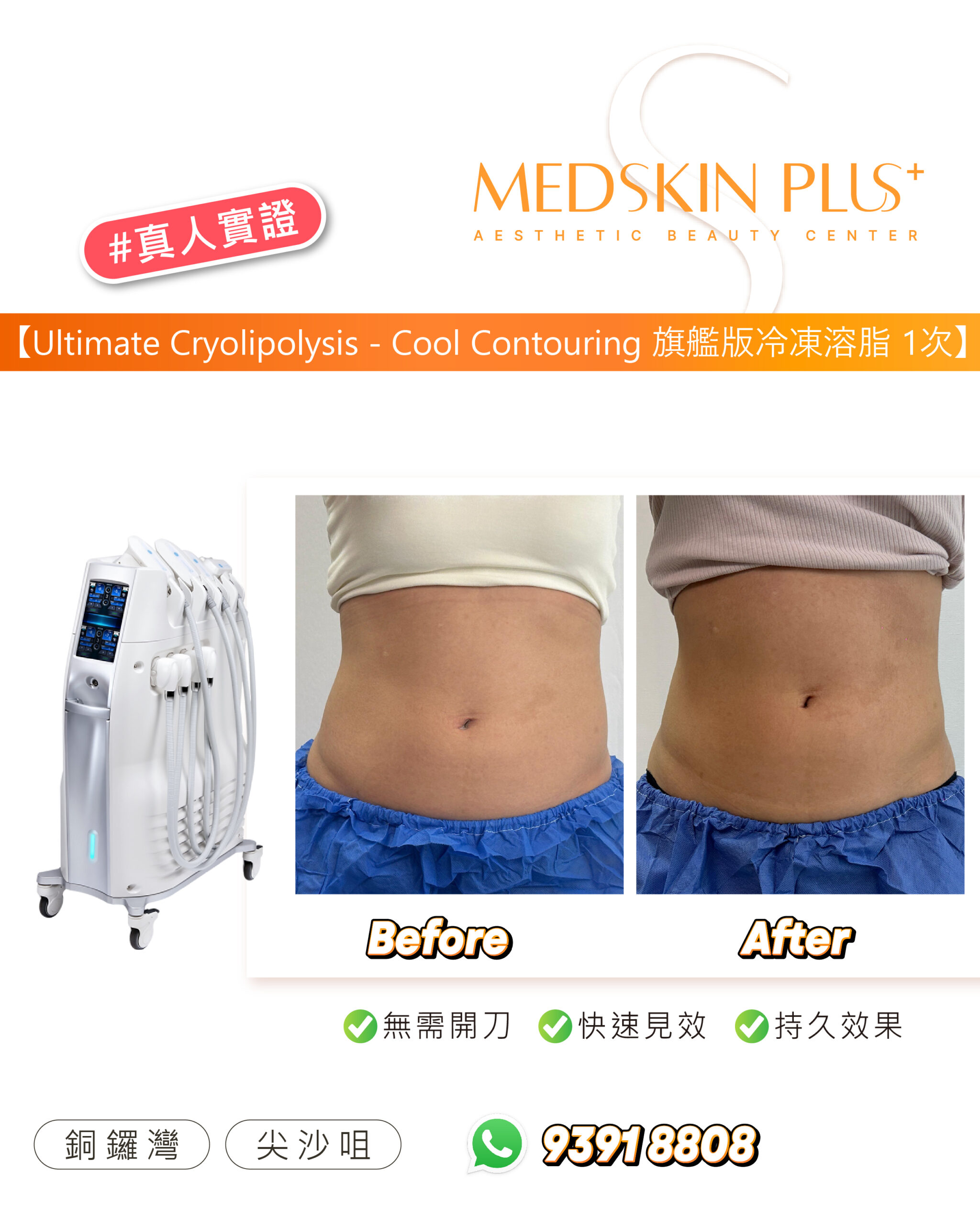 MEDSKIN PLUS+ 旗艦版冷凍溶脂1次的真人實證圖，左邊是白色冷凍溶脂儀器，右邊並列腹部 Before 與 After 照片，下方標示無需開刀、快速見效及持久效果