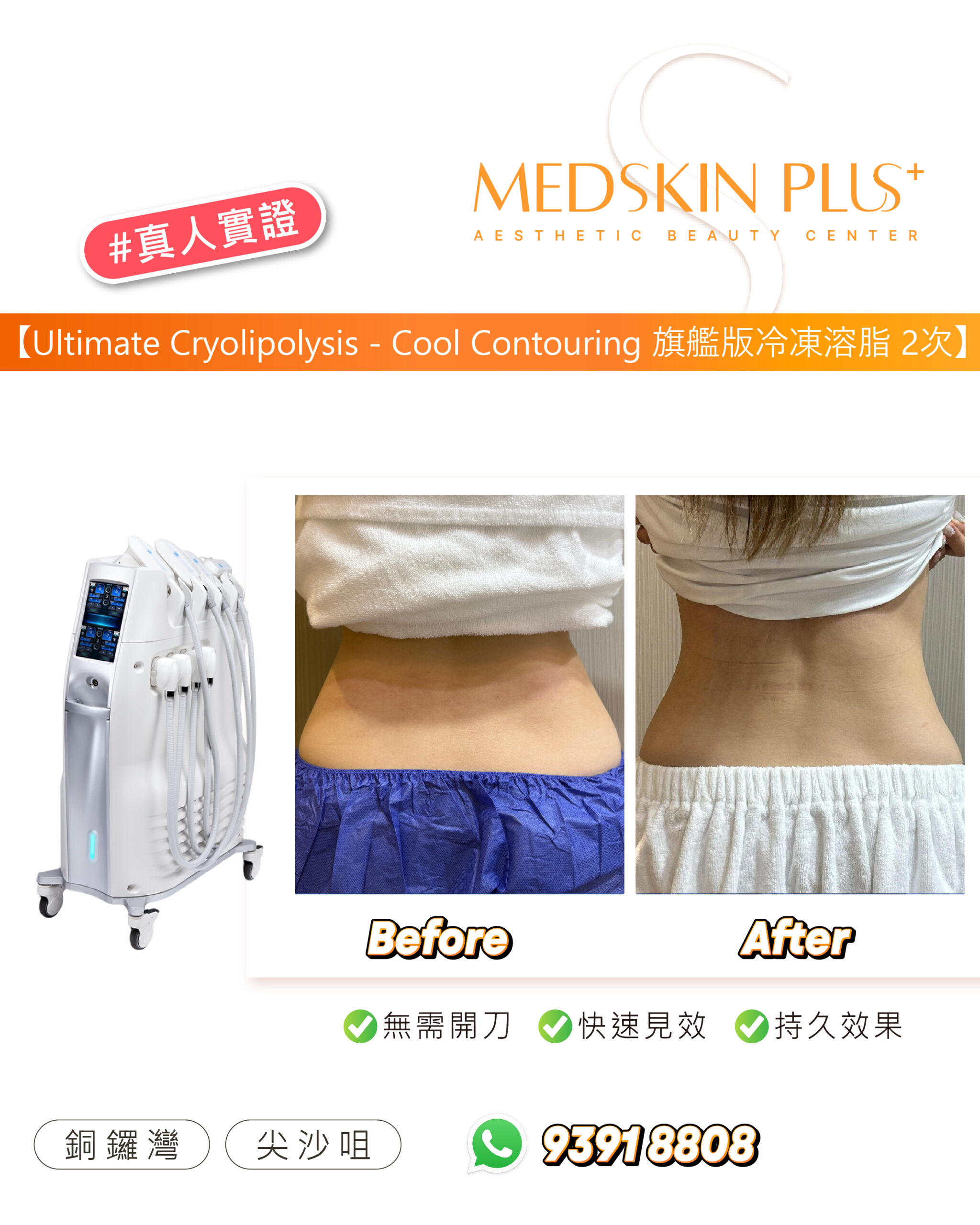 MEDSKIN PLUS+ 旗艦版冷凍溶脂2次的真人實證圖，左邊是白色冷凍溶脂儀器，右邊並列腹部 Before 與 After 照片，下方標示無需開刀、快速見效及持久效果
