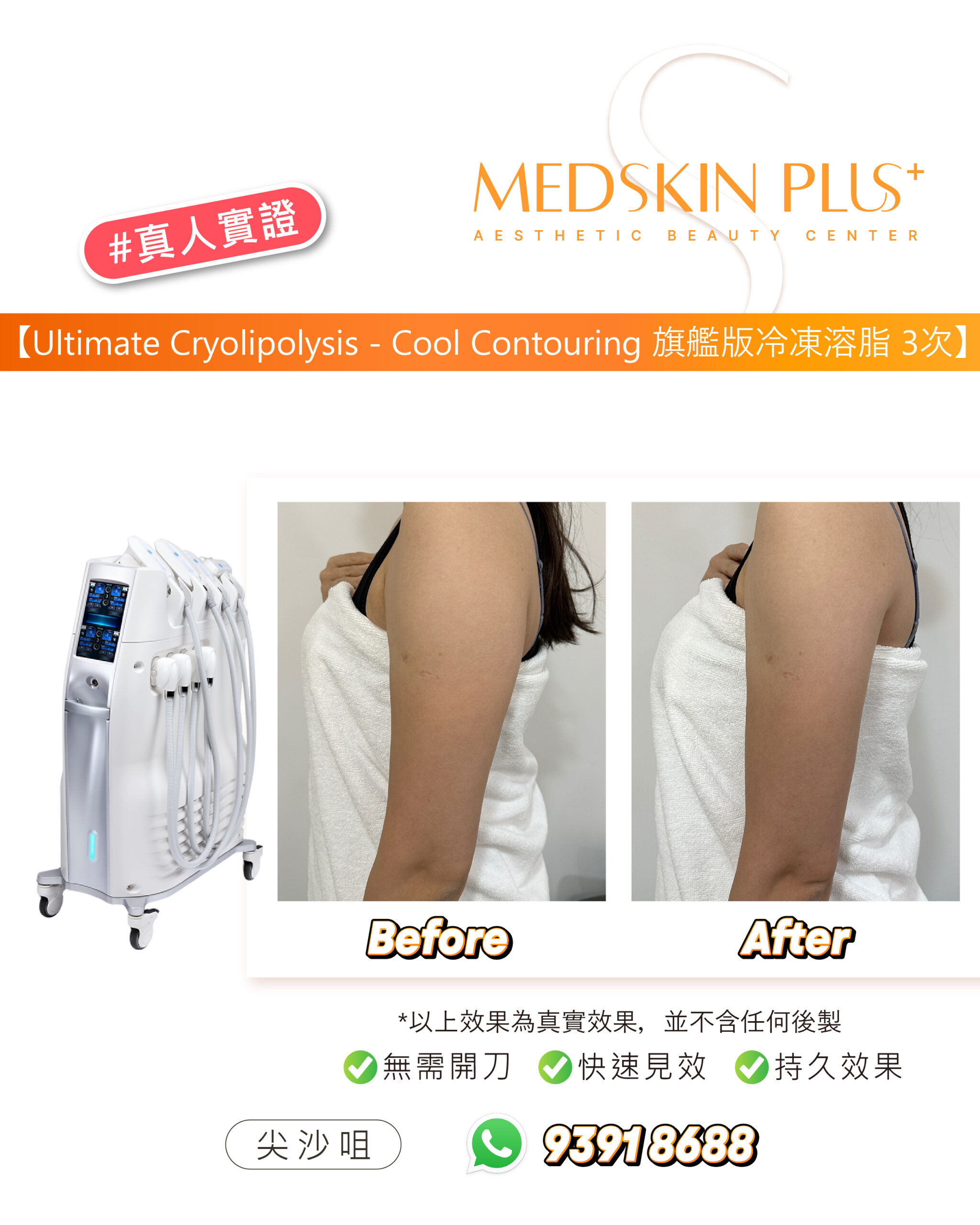 左側為冷凍溶脂儀器，右方為同一女士手臂的 Before 與 After 相片，示範者以白色毛巾遮蓋身體。