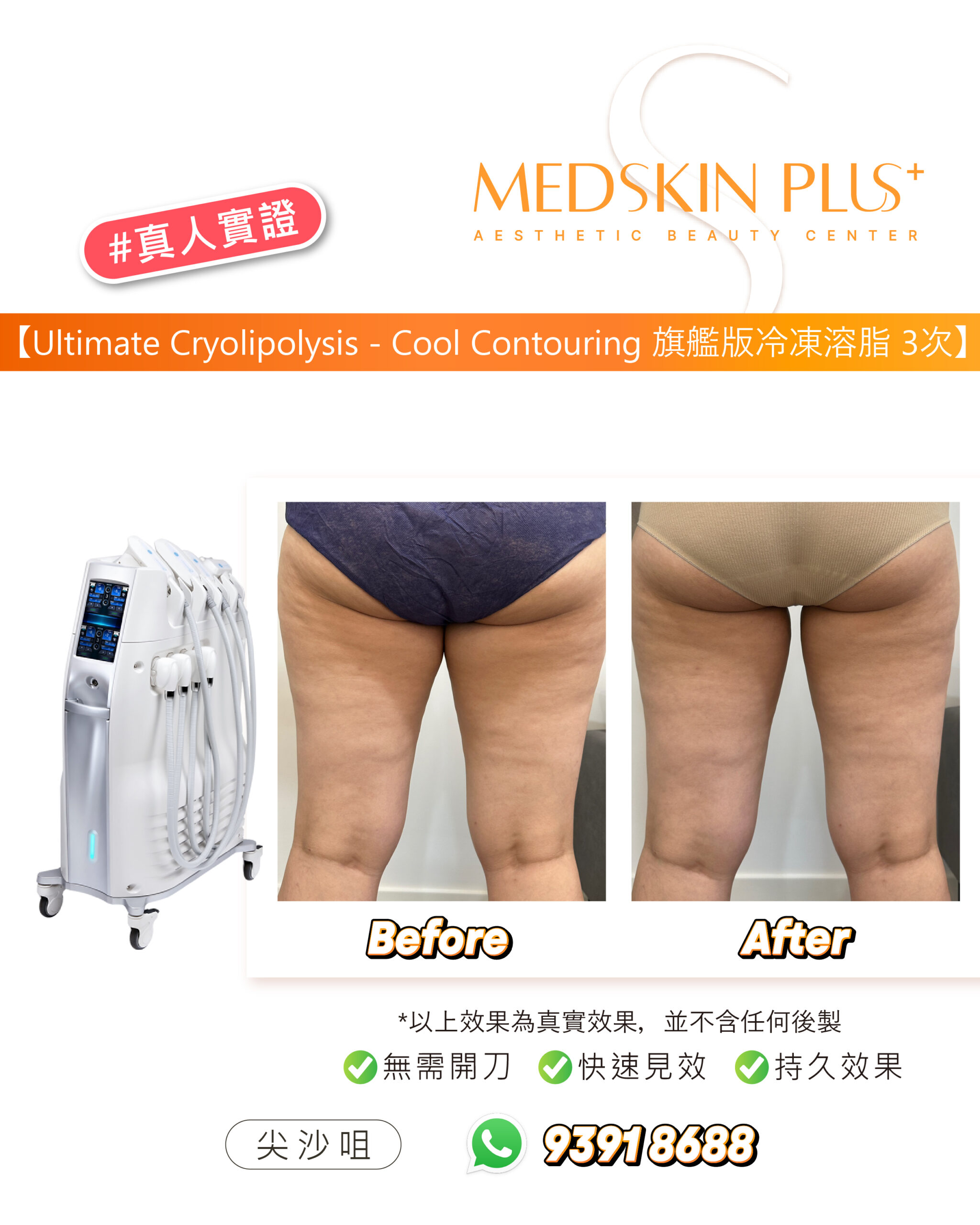 女士大腿及臀部後方的療程前後對比：左格標 Before、右格標 After，白色背景，左側為白色冷凍溶脂儀器，橙色標題標示療程名稱與次數。