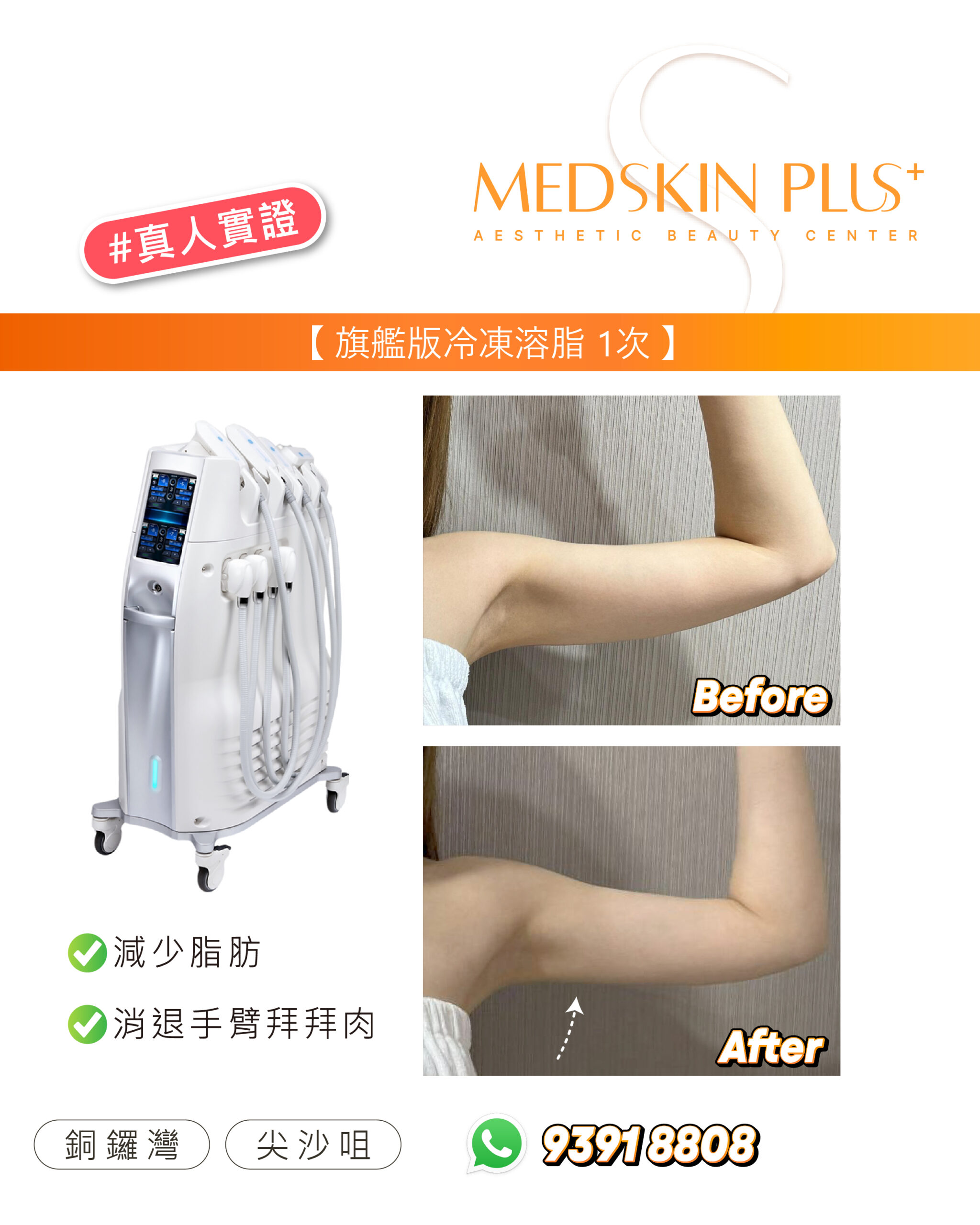 女士手臂上舉的療程前後對比，上格標 Before、下格標 After，背景為淺灰色直紋牆，下格以白色虛線箭頭指出上臂內側位置，左側為白色冷凍溶脂儀器。
