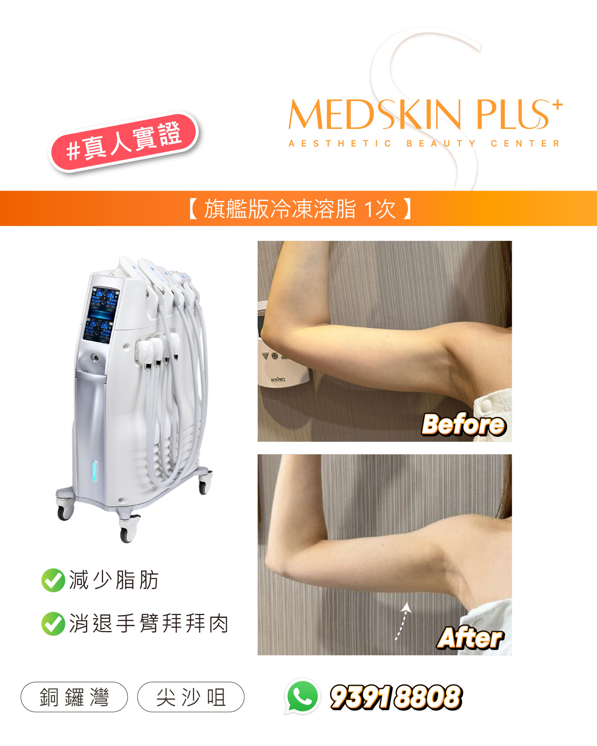 女士手臂上舉的療程前後對比，上格標 Before、下格標 After，背景為淺灰色直紋牆，Before 格左側見一個白色牆上給皂裝置，左側為白色冷凍溶脂儀器。