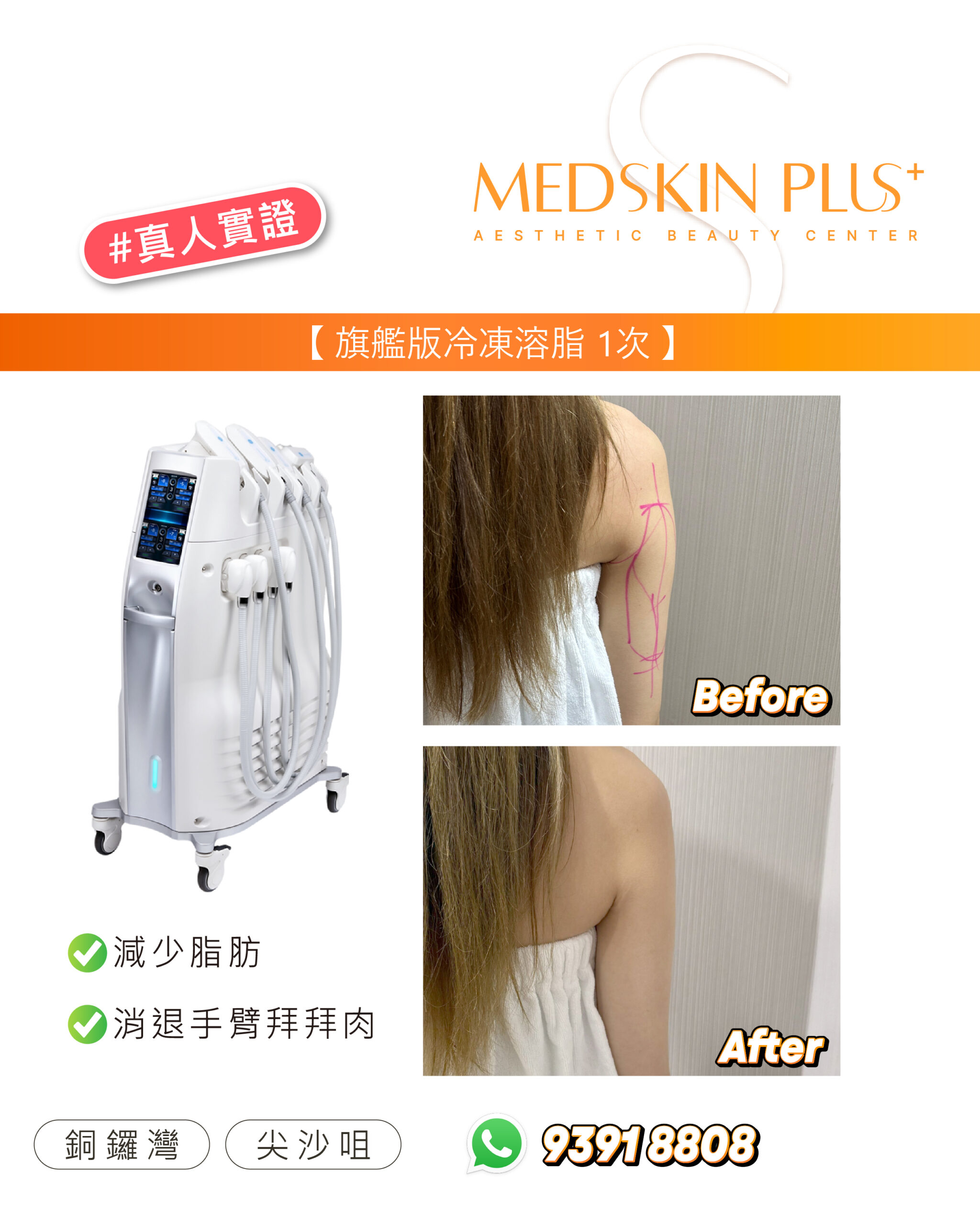 左側為白色冷凍溶脂儀器，右方為同一女士手臂的 Before 與 After 相片，Before 相片上以粉紅色線條標出手臂範圍。